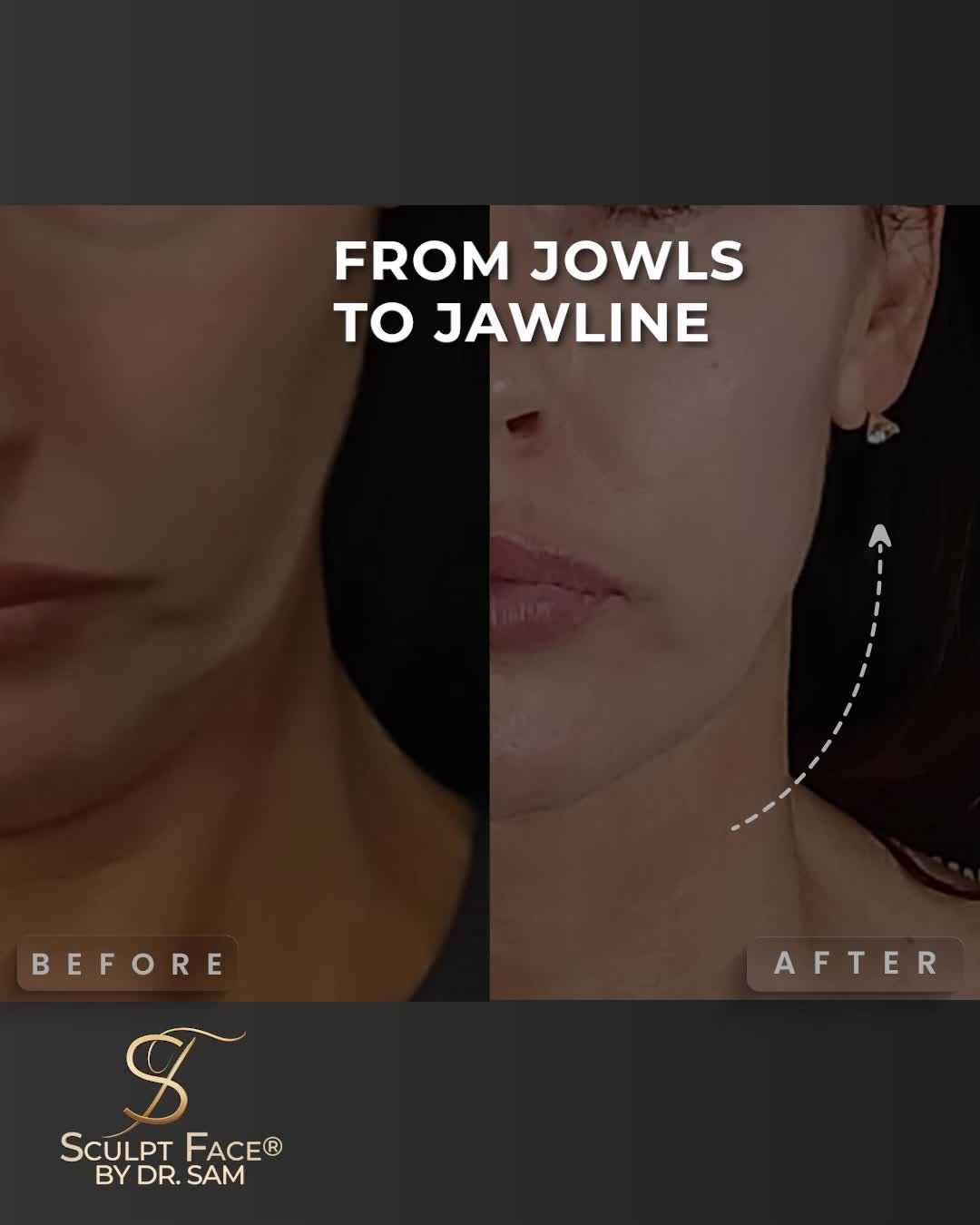 Jawline sagging isn’t just age.
It’s volume loss, skin laxity, and heaviness—especially around the jowls and under the chin.
Dr Sam's Sculpt Face Protocol™ targets all of it. One treatment. Precision results:
* Sharper jawline
* Lower face less heavy
* Smoother under-chin
* Firmer neck
* Lifted proportions
#No filters #No fillers #No surgery.
Just skill, science, and next-gen aesthetics.
It's time to elevate your glow.
Discover the Sculpt Face Protocol™, a surgical approach to non-surgical rejuvenation.
By 𝓓𝓻. 𝓢𝓪𝓶 𝔁
#SculptFace
#SculptFaceProtocol
#EndoliftUK
#endolift
#endoliftlaser
#endolifting
#endolifttreatment
#endoliftingfacial
#NonSurgicalFacelifts
#SkinRejuvenation
#SkinGoals
#GlowFromWithin
#CollagenBoost
#SkinTightening
#SkinTighteningTreatment
#facialrejuvenation
#laserrejuvenation
#nonsurgical
#aesthetictreatments
#liverpoolaestheticsclinic
#manchesteraestheticsclinic
#leedsaestheticsclinic
#sheffieldaestheticsclinic
#greatermanchesteraesthetics
#cheshireaestheticsclinic