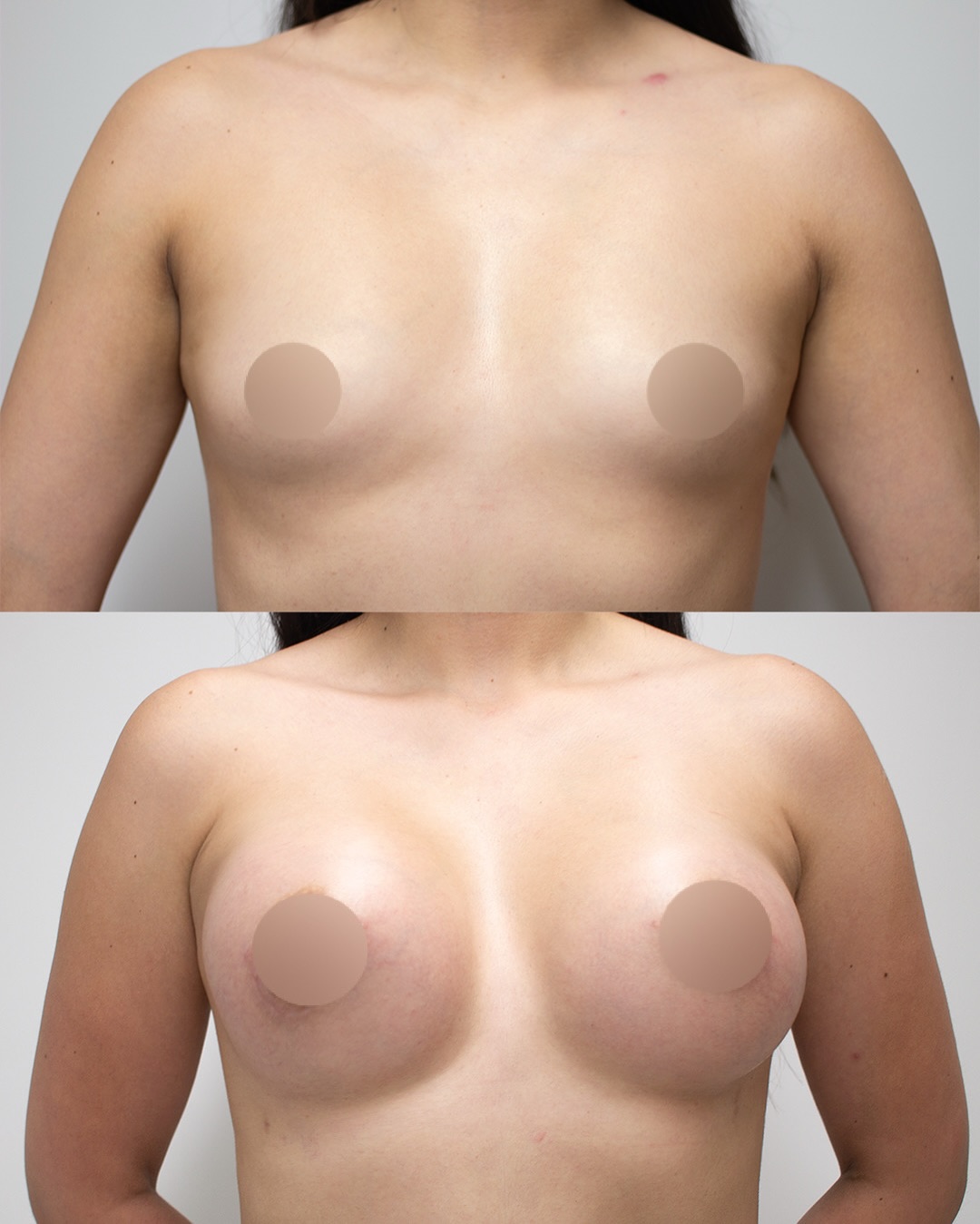 Hoy queremos mostrarles este hermoso resultado de Aumento Mamario con aproximadamente 6 meses de evolución 💞