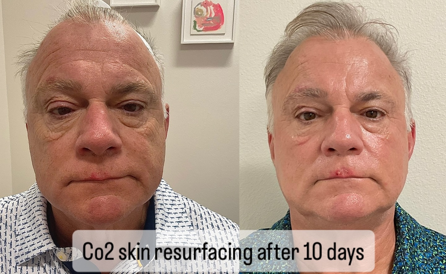 #co2laser #co2resurfacing #age #wrinkles #sarasota #siestakeybeach #siestakey #nokomisbeach #stpetersburgflorida #lakewoodranchflorida #capricebeautybar #