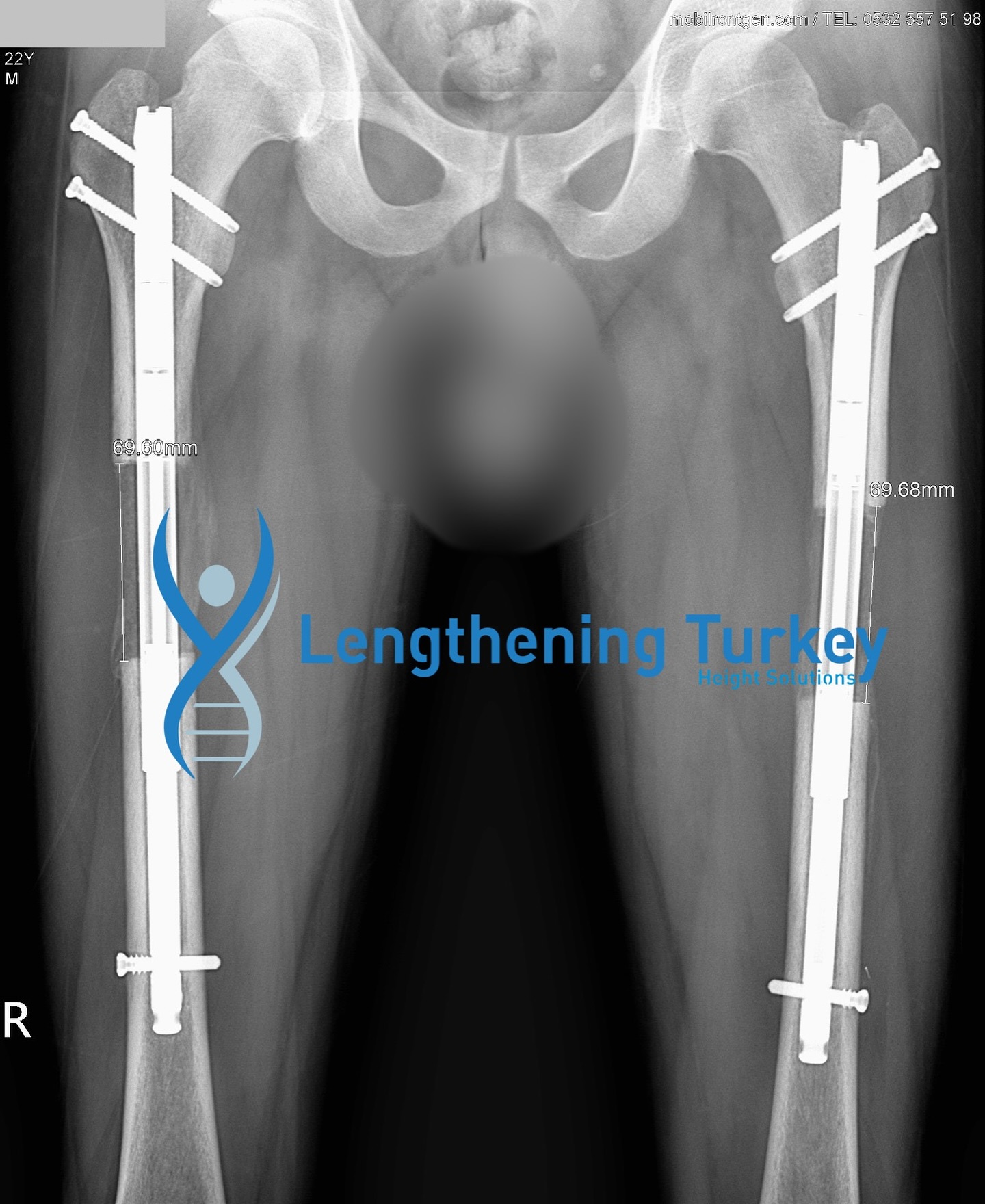 ✨ Update Time! ✨
From the first turn of the remote to today’s milestone — 6.9 cm gained with the PRECICE method! 📏💪
Steady progress, strong determination, and a smooth journey so far. 🦵🔧
We’re not done yet — every day brings us closer to his final goal! 🚀
Informational/Educational only — not medical advice.
Evaluation & treatment are provided only by authorized healthcare facilities and the treating physicians.
#骨延長 #Beinverlängerung #腿延长
#limblengthening #leglengthening #heightextension #Quadrilateral #Precice #LON #LONsurgery #heightincrease #heightgrowth
#PreciceLengthening #HeightJourney #LegLengthening #PatientSuccess #LengtheningTurkey