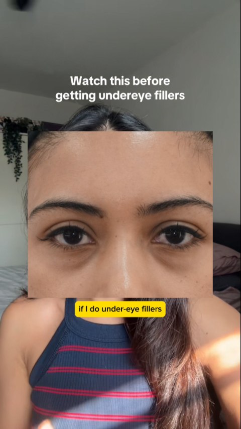 💉✨ Undereye fillers often get a bad rep for their risks. But when done right, they can deliver instant, visible results that refresh and brighten your whole look. 👀✨
If your eyes are giving “tired” even after 8 hours of sleep, this might just be the treatment that turns it around.
When in doubt, do your homework, or better yet, book a consultation with a trained medical aesthetics doctor who can walk you through the benefits and the risks before you decide.
⚠️ Remember: Confidence starts with informed choices 😉