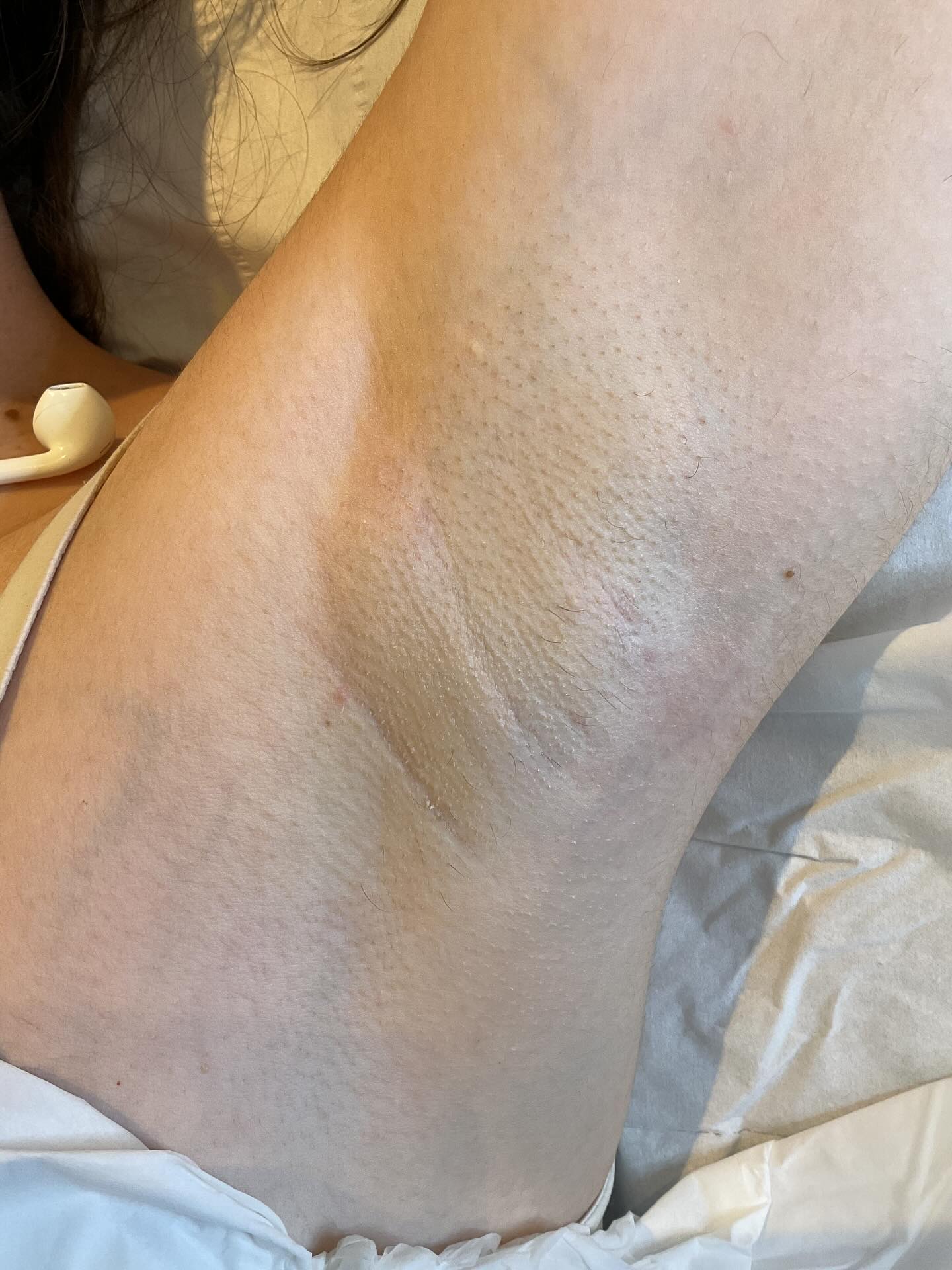 Swipe to see the before 👀
Incredible results from one of our maintenance clients — she hasn’t shaved since her last session!
✨ 80- 90% permanent hair reduction with only a few fine, scattered hairs remaining
✨ No more shadowing and significantly reduced density
📍 Underarm treatments now just £30!
🎁 Free consultation and patch test included
Ready to get started? Message us today! 💬