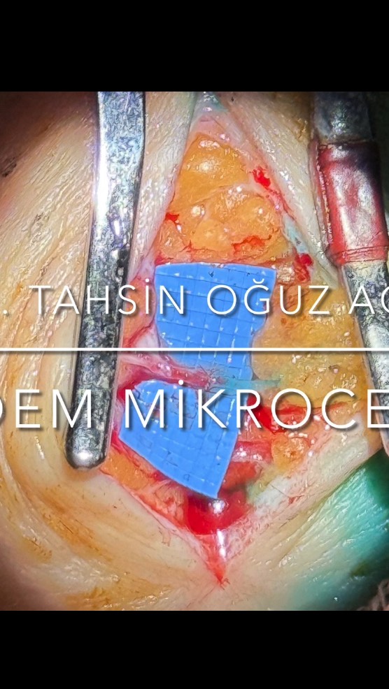 Lenfödem mikrocerrahisi ve tedavisi
Lenfödem Cerrahisi
Lenfödem Hastalığı erken dönemlerden başlayarak cerrahi ile tedavi edilmesi gereken bir durumdur.
Lymphedema is a condition that requires surgical treatment starting from its early stages.
☎️+90 544 971 4801
Doçent Dr. TAHSİN OĞUZ ACARTÜRK
Plastik, Rekonstrüktif ve Estetik Cerrahi
@dr.oguzacarturk
#Lenfödem #filhastalığı #fizyoterapi #fizyoterapist #lipödem #lipedema #lymphedema #lva #plastikcerrahi #estetikcerrahi #izmir #istanbul #ankara #memekanseri #liposuction #mikrocerrahi #microsurgery #lenfödemcerrahisi #lenfödemterapisi #fiziktedaviverehabilitasyon