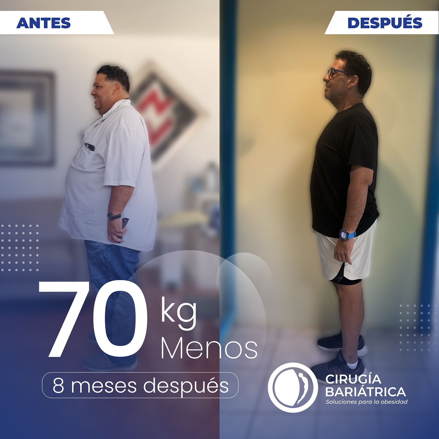 En solo 8 meses logró transformar su vida perdiendo 70 kg gracias a la cirugía bariátrica realizada por el Dr. Bolaños y su equipo. Un proceso acompañado de profesionalismo, tecnología de vanguardia y un grupo humano que cambia vidas.✨✨✨
In just 8 months, he transformed his life by losing 154 lbs thanks to the bariatric surgery performed by Dr. Bolaños and his team. A journey guided by professionalism, cutting-edge technology, and a dedicated group that truly changes lives. ✨✨✨
#bariatrica #bariatric #health #healthy #healthychoices #weightlosssurgery #weightlosssurgery