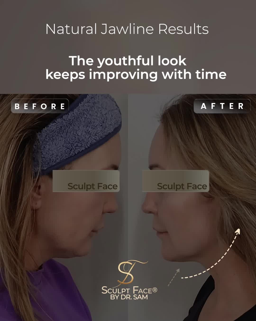 Prioritize your wellbeing and make space for the things that bring you joy. ✨
This isn’t about chasing quick fixes.
Results are designed to keep improving over time and working with your skin to lift, refine, and rejuvenate naturally.
In just one session, you’ll see a more defined jawline, smoother neck, brighter skin, and under chin fat reduced.
But the true transformation is in how your results continue to refine, week after week.
Because aesthetics, when done the Sculpt Face® way, is about renewal, balance, and care that lasts.
#No filters #No fillers #No surgery.
It's time to elevate your glow.
Discover the Sculpt Face Protocol™, a surgical approach to non-surgical rejuvenation.
By 𝓓𝓻. 𝓢𝓪𝓶 𝔁
#SculptFace
#SculptFaceProtocol
#EndoliftUK
#endolift
#endoliftlaser
#endolifting
#endolifttreatment
#endoliftingfacial
#NonSurgicalFacelifts
#SkinRejuvenation
#SkinGoals
#GlowFromWithin
#CollagenBoost
#SkinTightening
#SkinTighteningTreatment
#facialrejuvenation
#laserrejuvenation
#nonsurgical
#aesthetictreatments
#liverpoolaestheticsclinic
#manchesteraestheticsclinic
#leedsaestheticsclinic
#sheffieldaestheticsclinic
#greatermanchesteraesthetics
#cheshireaestheticsclinic