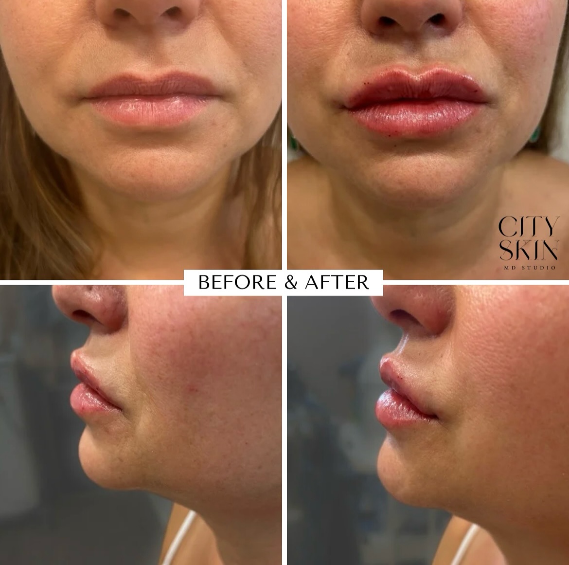 ✨ Before & After Special-Labor Day Promo ✨
Refresh your look this holiday! 💋👀
Option 1️⃣ Lip Border Enhancement
✔ Natural definition with ½ syringe
✔ Soft, subtle contour
✔ Kissable confidence
Option 2️⃣ Under Eye Refresh
✔ Brighten & smooth hollows
✔ Reduce tired look
✔ Subtle, rested results
🌟 SPECIAL PROMO – Only $299! 🌟
Choose your treatment → $299
🗓 Offer valid until Labor Day
📍 CITYSKIN MD
9140 Westview Rd, Suite 133
Lone Tree, CO 80124
📞 Text LABOR to 720‑260‑1004 with your name and email. ✨
✨ Antes y Después-Promoción del Día del Trabajo ✨
¡Renueva tu look este feriado! 💋👀
Opción 1️⃣ Definición Natural del Borde de los Labios
✔ Definición natural con ½ jeringa
✔ Contorno suave y sutil
✔ Confianza lista para besar
Opción 2️⃣ Tratamiento de Ojeras
✔ Ilumina y suaviza las ojeras
✔ Reduce el aspecto cansado
✔ Resultados sutiles y descansados
🌟 PROMOCIÓN ESPECIAL – Solo $299! 🌟
Elige tu tratamiento → $299
🗓 Promoción válida hasta el Día del Trabajo
📍 CITYSKIN MD
9140 Westview Rd, Suite 133
Lone Tree, CO 80124
📞 Envía mensaje LABOR a 720‑260‑1004 con tu nombre y correo electronico.✨
#cityskinmd #fillersinjection #suppoertsmallbusiness #labordayweekend #lipboardertreatment #flawlesslips