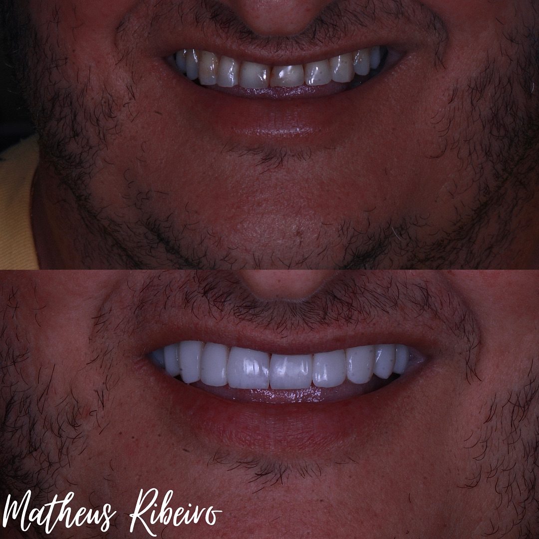 #OdontologiaEstética #Zircônia #zibase #ImplantesDentários #PróteseSobreImplante #Dentista#facetas #lentes #implantes #saudebucal #odontologia #tratamentoodontologico #dente #estetica #anapolis #implantezirconia #odontologiabiológica #odontolgiaintegral #odontologiabiologicaeintegrativa #dentistaanapolis #scannerintraoral