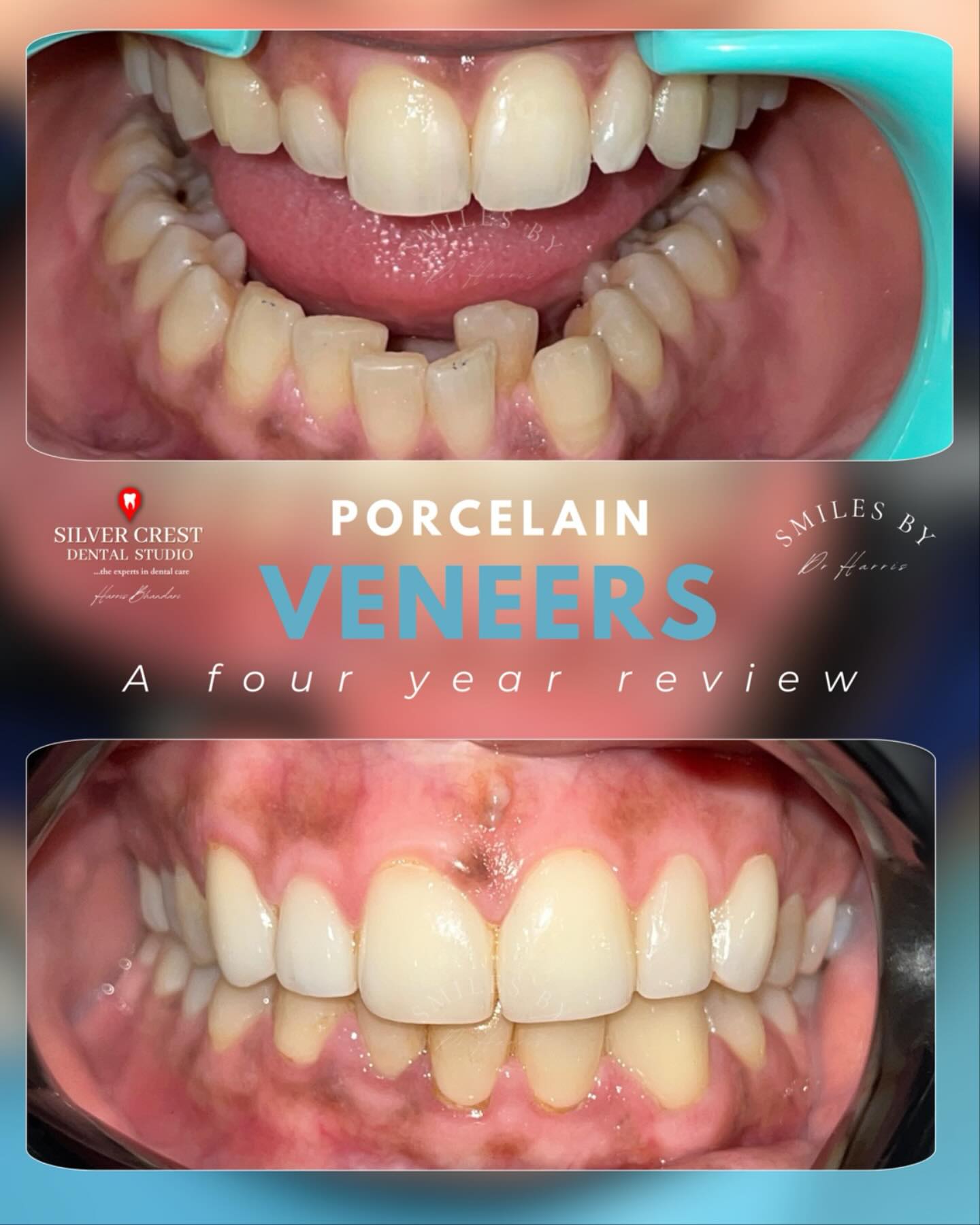 Veneers that don’t just transform a smile—they preserve it. 4 years later, still flawless, still radiant.” ✨
#TimelessElegance#LuxeSmiles#SmileStory #LuxeSmile #SmileJourney #ConfidenceStartsHere#bookyoursmile#cosmeticdentistdelhi#smilemakeover#fyp#viralpost#SmileDesign #SmileTransformation #LuxuryDentistry #BeforeAndAfter #DentalArtistry #PerfectSmile”