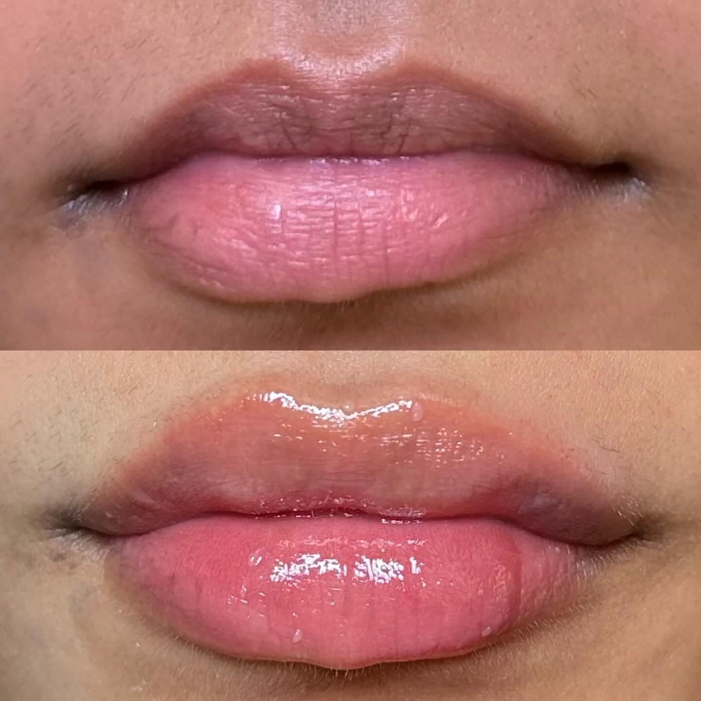 Improving symmetry and the lip ratio to create beautifully natural looking lips using Restylane 💋
#lipfillerlondon #naturallipfiller #aestheticnurselondon #aestheticslondon #facialbalancinglondon #juliehornelondon