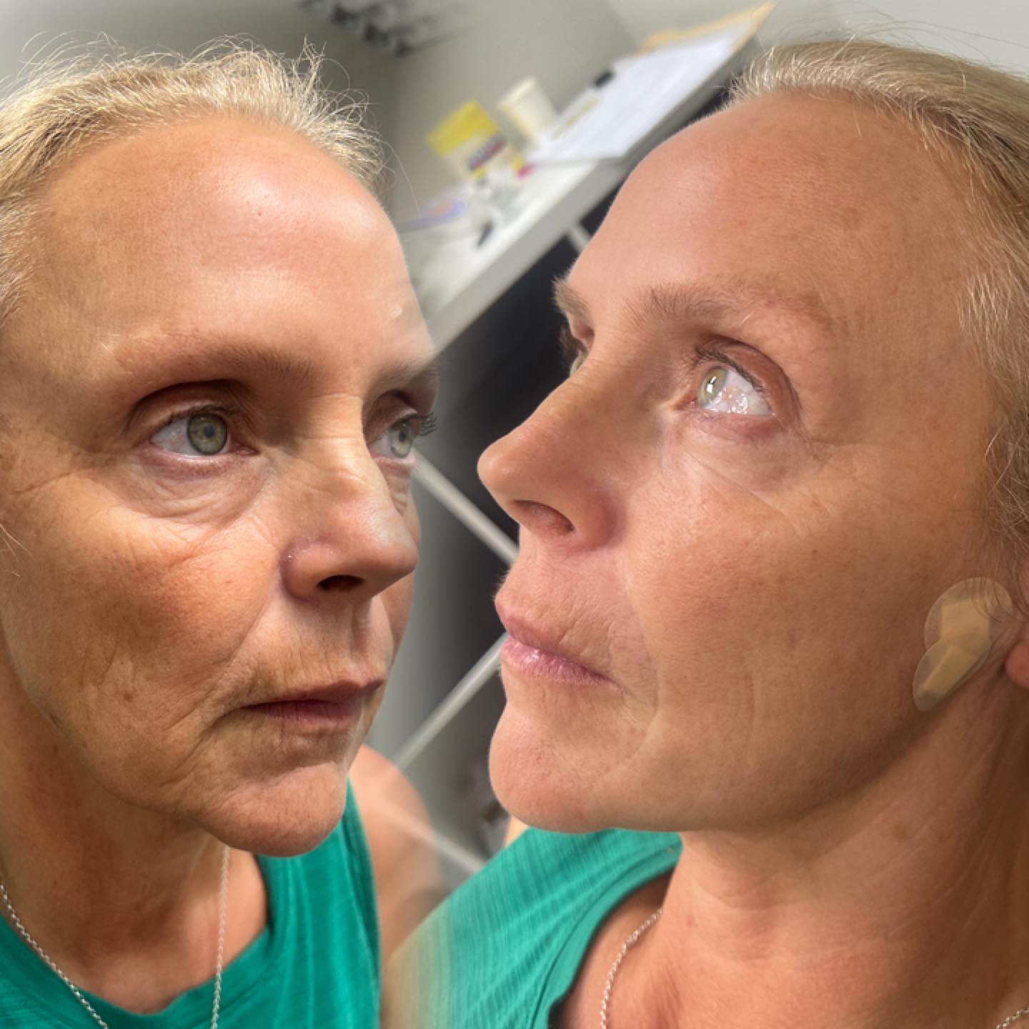 Achieve a more youthful, sculpted look with 8 Cog Threads – the ultimate non-surgical lift. 💉 Available at The Beauty Lab North East 💕
📍 Book your consultation today and discover the power of threads for natural, long-lasting results.
#CogThreads #ThreadLift #NonSurgicalLift #JawlineContour #FacialRejuvenation #YouthfulSkin #SkinTightening #BeautyLabNorthEast #AdvancedAesthetics #confidenceboost