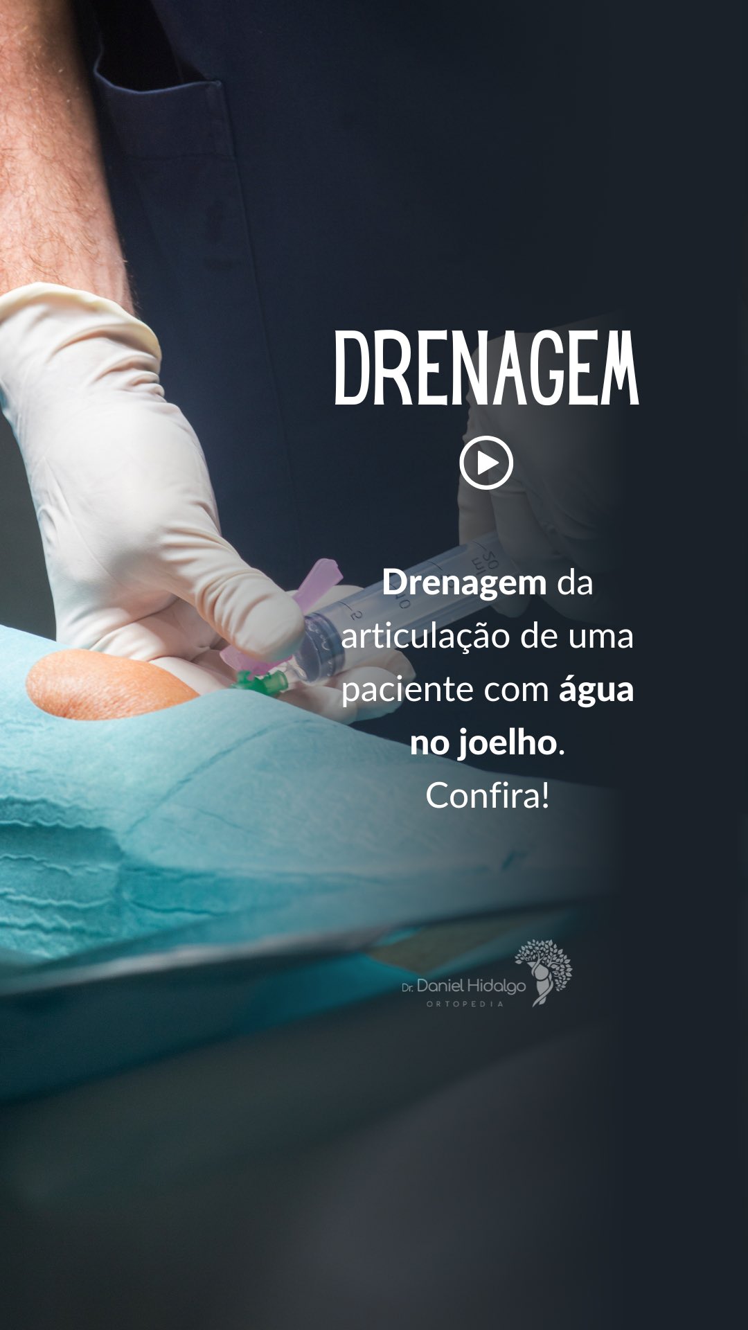 💉Drenagem do joelho de uma paciente com artrose e inflamação. O aumento de volume do líquido articular pode ser bastante incômodo e pode ser drenado para proporcionar alívio ao paciente.
Dr. Daniel Hidalgo - Médico Ortopedista
CRM-SP 137.057 | RQE 41.112
Membro da Sociedade Brasileira de Ortopedia e Traumatologia (SBOT)
Membro da Sociedade Brasileira de Cirurgia do Joelho (SBCJ)
#artrose #aguanojoelho #drenagem #artrocentese #ortopedia #ortopedista #jardins #klabin #chacaraklabin #altodepinheiros #alphaville #alphavilleearredores
#ortopedia #joelho #cirurgiadojoelho #artroscopia