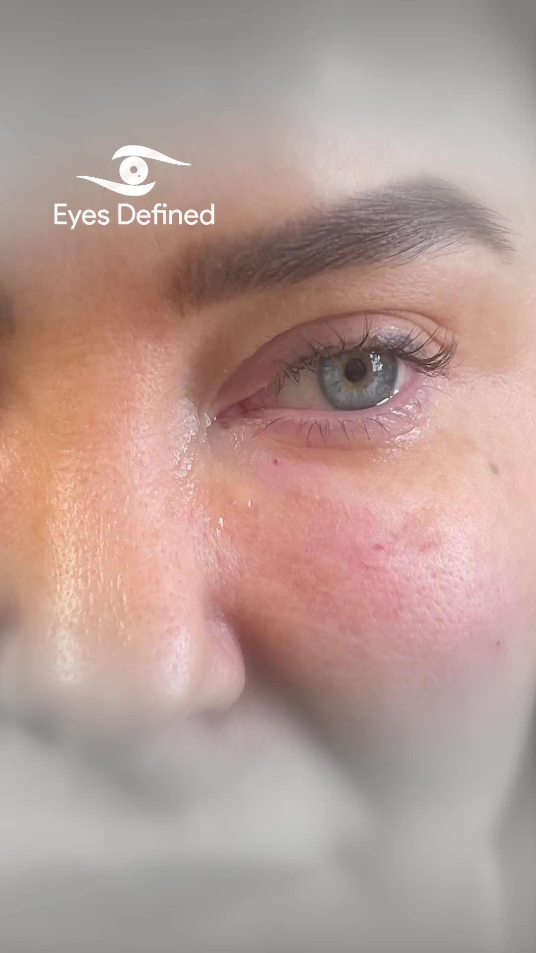 When it comes to correcting the Tyndall effect under the eyes, complete dissolving isn't always necessary—or ideal. In this case, we selectively dissolved filler in the mid-face and tear trough area to reduce the blue hue while preserving volume and contour.
This technique requires precision, experience, and a deep understanding of facial anatomy. The goal? Subtle correction without overcorrection. 👁💉
📍Performed in London
📆 Consultations available
#OculoplasticSurgeon #FillerCorrection #TyndallEffect #TearTroughFiller #Hyaluronidase #UnderEyeFiller #FillerDissolving #MidfaceFiller #SubtleEnhancement #LondonAesthetics #FacialAnatomy #NaturalResults #EyeRejuvenation #ExpertInjector #AestheticMedicine