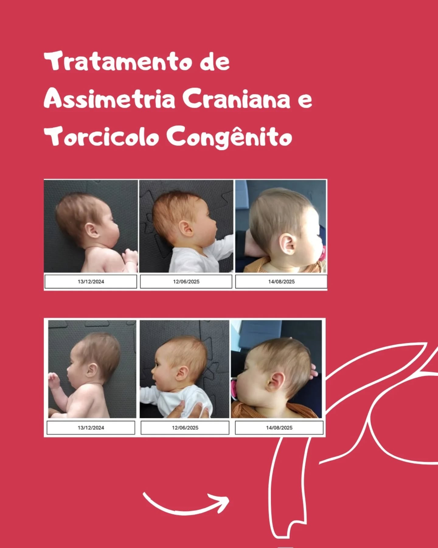 Resultado lindo❤️
Método De Setti @carolinadesetti
Fisioterapeuta @fisiomartha_bbeatriz
Dra. Martha Batista Beatriz
CREFITO 3 337902-F
#fisioterapia #fisioterapiapediatrica #fisioterapianeuropediatrica #metododesetti
#assimetriacraniana #torcicolocongenito