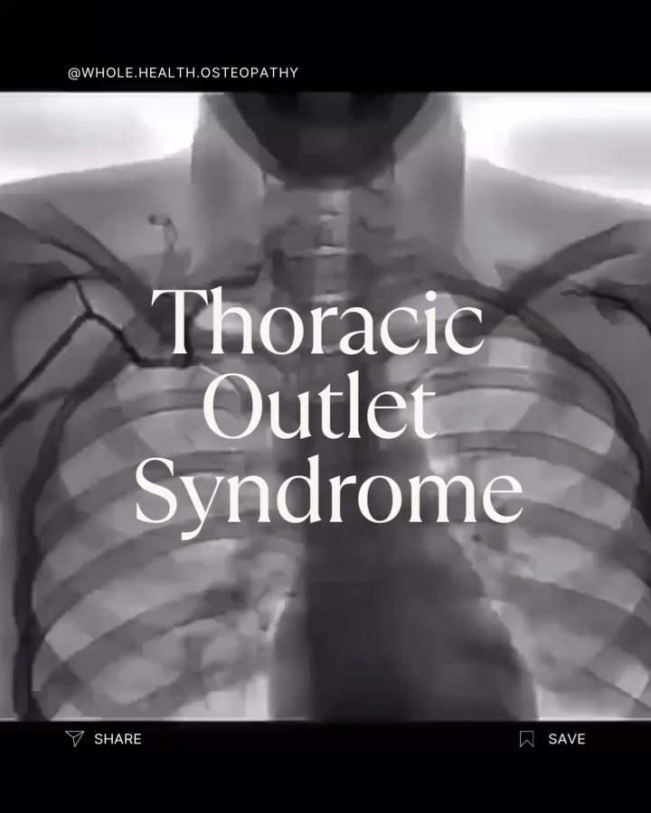 I’ve been seeing a lot of Thoracic Outlet Syndrome (TOS) in the clinic lately, so I thought I’d share a bit more about it because, honestly, it can look like so many different things that people often don’t realise what’s going on.
In simple terms, TOS happens when nerves or blood vessels get squeezed between your collarbone and first rib. Sounds small, but it can cause a big range of issues from tingling fingers to swollen arms.
👉 The 3 types of TOS:
Nerve-related (Neurogenic): Tingling, numbness, weakness or that annoying “dead arm” feeling.
Vein-related (Venous): Puffiness or swelling in the arm/hand, heaviness, and sometimes even chest veins popping up after activity.
Artery-related (Arterial): Super rare but important. Think cold fingers, poor circulation, even sores that don’t heal.
Who gets it?
I see it in swimmers, tennis, volleyball, gym-goers, but also in people who sit at desks all day, carry heavy bags, or just have postures that make the area more cramped.
SO, if you’re noticing ongoing tingling, swelling, or weakness in your arms or hands, it’s not “just nothing.” It could be TOS, and the good news is there are ways to manage it once we know what we’re dealing with.
Full video on the last slide!
#ThoracicOutletSyndrome #ShoulderPain #NeckPain #ArmPain #HandPain #SportsInjuries #SouthMorangOsteopathy