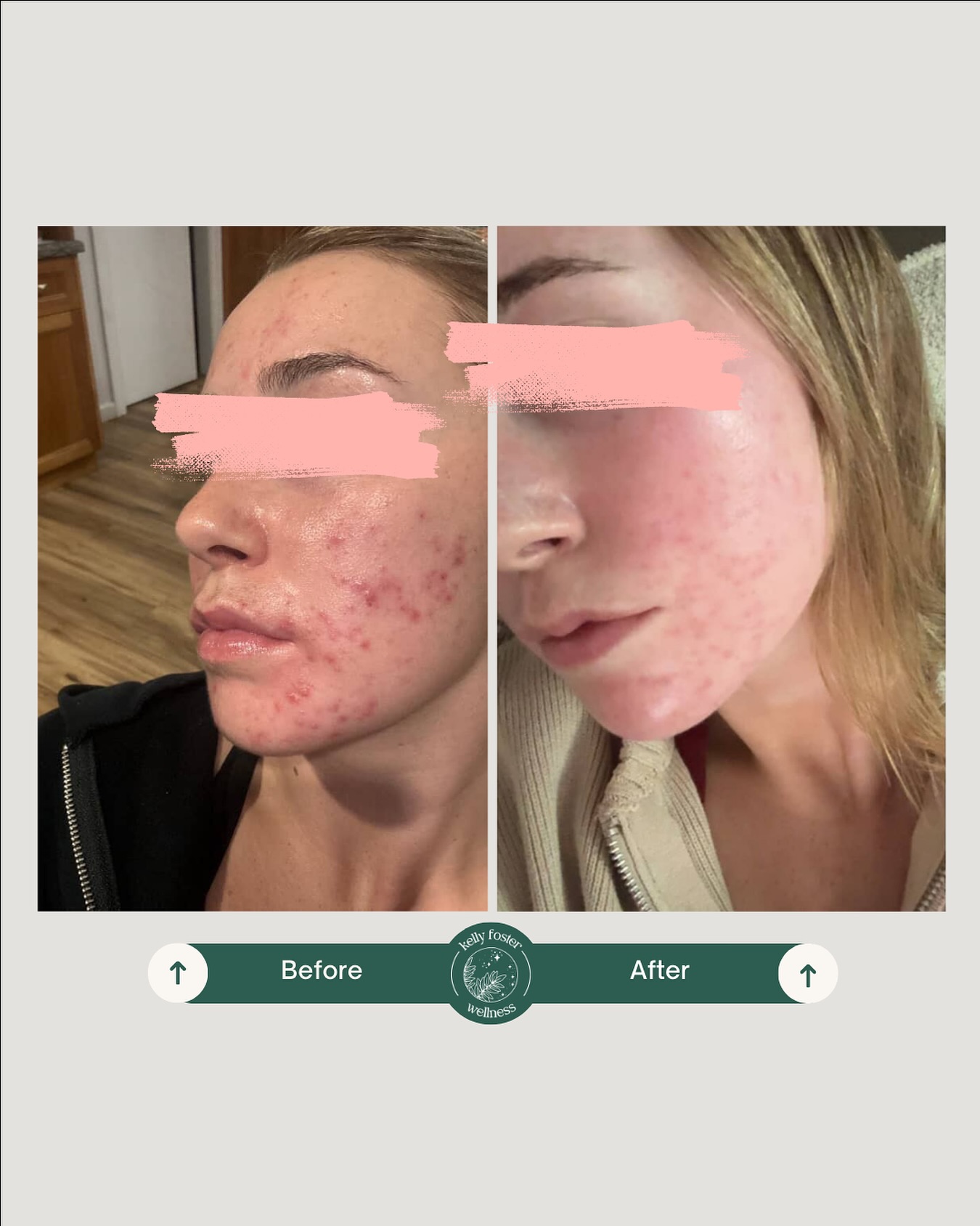 Healing skin from the inside out 🙌
This beautiful transformation is what happens when we address acne at its root cause and then pair it with targeted topical therapy.
✔️Her journey so far:
👉We first calmed her nervous system + supported liver/detox pathways.
👉Stool testing revealed low beneficial bacteria + high inflammatory markers.
👉A gut protocol helped restore balance + reduce inflammation.
Just ONE round of skin needling boosted repair + rejuvenation.
Now her internal environment is healing, which means topical treatments can focus more on repairing scarring and rebuilding healthy skin texture.
The result? Clearer, calmer, glowing skin
➡️ Ready to start your own skin healing journey? DM me to book your consult or free discovery call.
#beforeandafter #acnetreatment #skinneedling #guthealth #acnejourney #acnecommunity #acnehealing #holisticskincare #treattherootcause #acnesupport #skincarethatworks #glowingskin