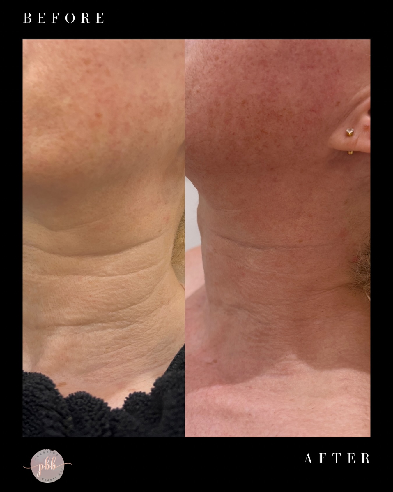 The neck is one of the toughest areas to treatāsometimes a neck lift is the only answer. But with the right plan (plus a little patience and trust), non-surgical results can be beautiful too. This wasnāt a quick fix; it took multiple sessions, two different treatments, and daily use of @vivierskin neck cream to get here.
.
.
.
.
.
#necktreatments #injectables #nurseinjectors #prestigebeautybar #dysport #botox #dermalfiller