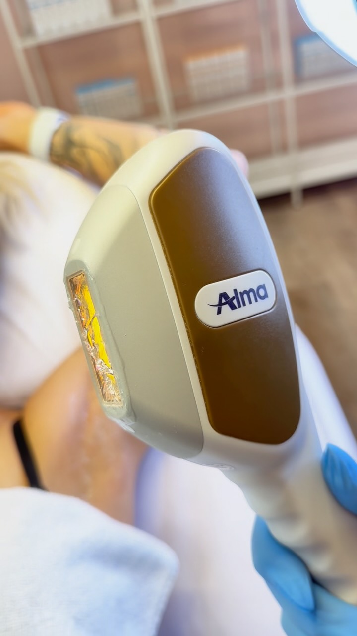 Alma laser karvanpoisto 🔥
IPL-valoimpulssin avulla pysyvästi eroon häiritsevistä karvoista vartalolla ja kasvoilla !
Hinnasto karvapoisto:
15min 120,-
30min 230,-
45min 350,-
60min 450,-