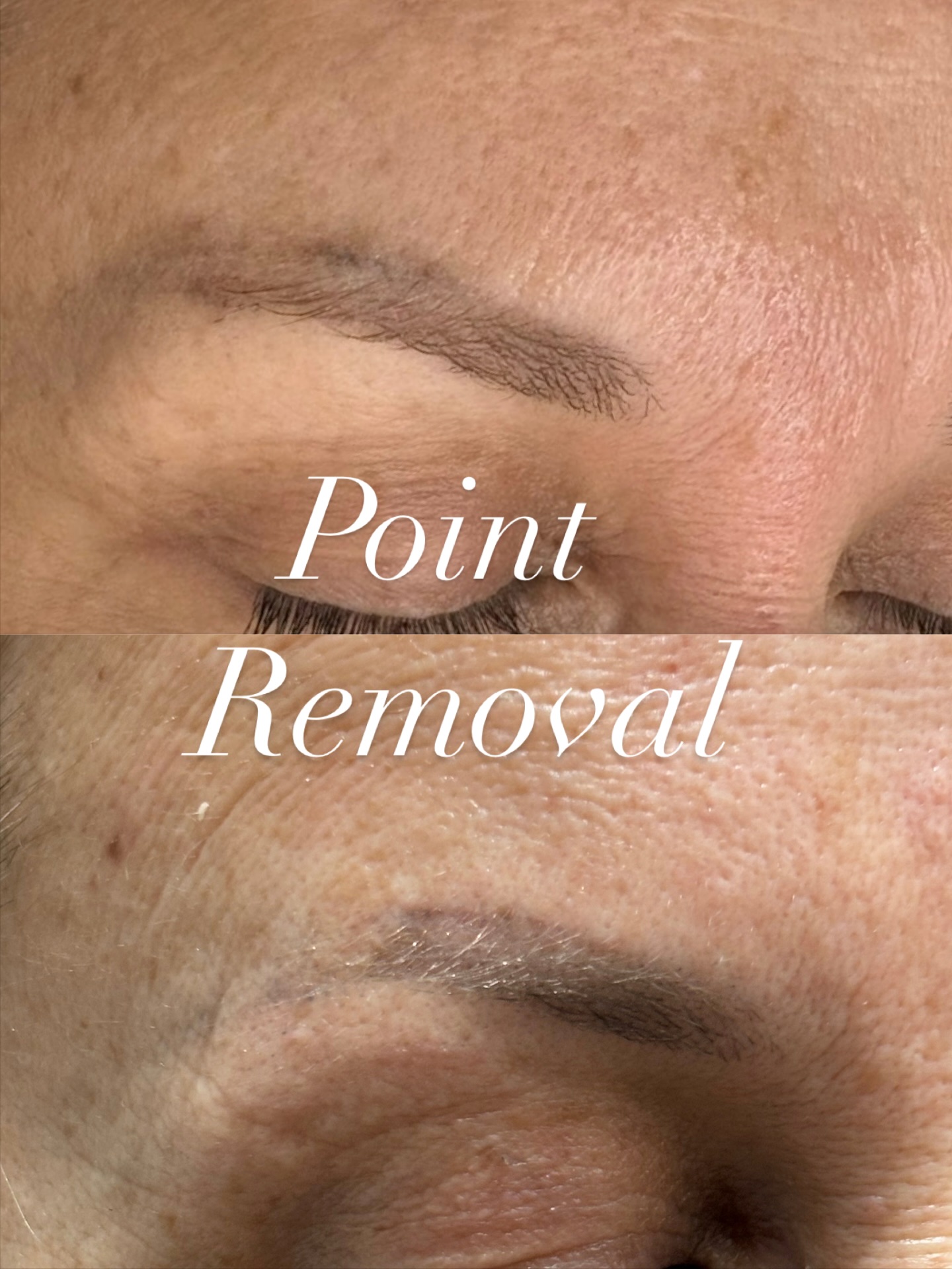 ✨ Point Removal for Old Microblading ✨
This client had microblading done at another salon about 4 years ago. During our consultation, we noticed some very deep lines that made it difficult to correct the shape. Instead of layering more pigment, we decided that the best option was removal first.
👉 After just one session of removal, the results are already amazing!
We’ll let the skin fully heal over the next 3 months, and after summer, we’ll create a fresh set of brows that truly enhance her natural beauty.
💡 Sometimes the best brows start with a clean canvas. If you’ve had old or uneven microblading and are unsure what to do next, removal might be the right path for you.
📩 DM me to book a consultation and see if brow removal is right for you!
#MicrobladingRemoved
#OldBrowsCorrected
#BrowsHealed
#BrowShapeFixed
#TattooRemoved
#BadBrowsCorrected
#BrowCorrectionDone
#RemovalSuccess
#PigmentRemoved
#BrowsRenewed
#BrowsTransformed
#PastMicrobladingFixed
#BrowsRedone
#BrowTattooGone
#FreshStartBrows