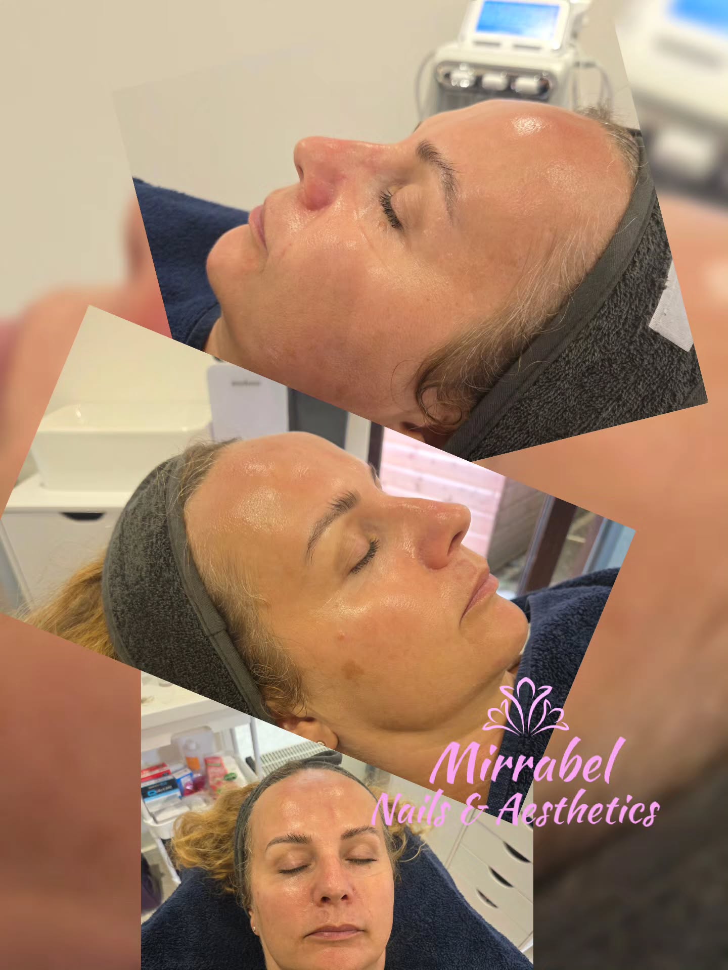 ⭐️GLOWING SKIN with HYDRO ULTIMATE FACIAL ⭐️
Rejuvenate your appearance and start fresh with healthy skin.
Hydro ultimate facial offers numerous benefits for skin, including deep cleansing, exfoliation, hydration and improved texture. It can help with issues like clogged pores, fine lines, wrinkles, and uneven skin tone, ultimately promoting a healthier, more radiant complexion.
#hydrofacial
#Altrinchamtoday #Hale #facialtreatment #skin #cloggedpores #dryskin #glowingskin #Wythenshawe