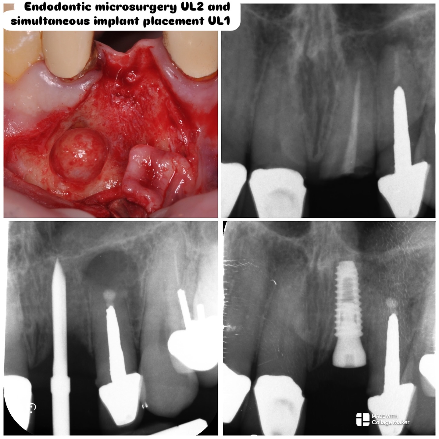 An interesting referral for Implant UL1. Discovered apical pathology on UL2. Implant placement in thin ridge with simultaneous apical microsurgery on UL2 with retrograde root filling. #nhs #treat #treatment #endowarrior #endodontia #rootcanaltreatment #rootcanaltherapy #endobelly #waves #waveonegold #saveteeth #endospecialist #treatyourself #simplicity #dentaltreatment #compositebonding #dentistry #endodontics #dentaltreatment #difficultendo #dentistrylife #dentistrylove #dentallife
