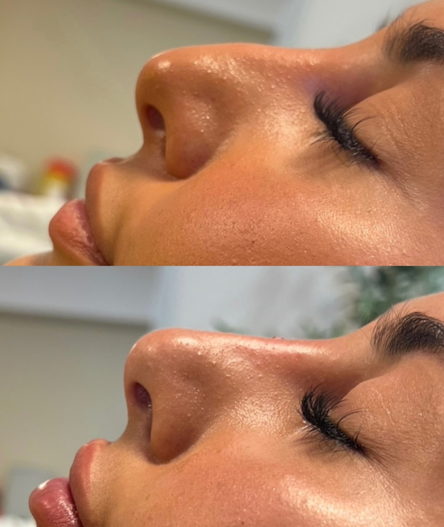 ✨ Avant / Après ✨
La magie de l’acide hyaluronique en quelques minutes seulement.
Un nez réharmonisé, sans chirurgie, sans éviction sociale, avec un résultat naturel et immédiat.
Technique : rhinoplastie médicale à l’acide hyaluronique
Durée : 15-20 minutes
Résultat : instantané
Parce que parfois, un petit détail change tout l’équilibre du visage 💫