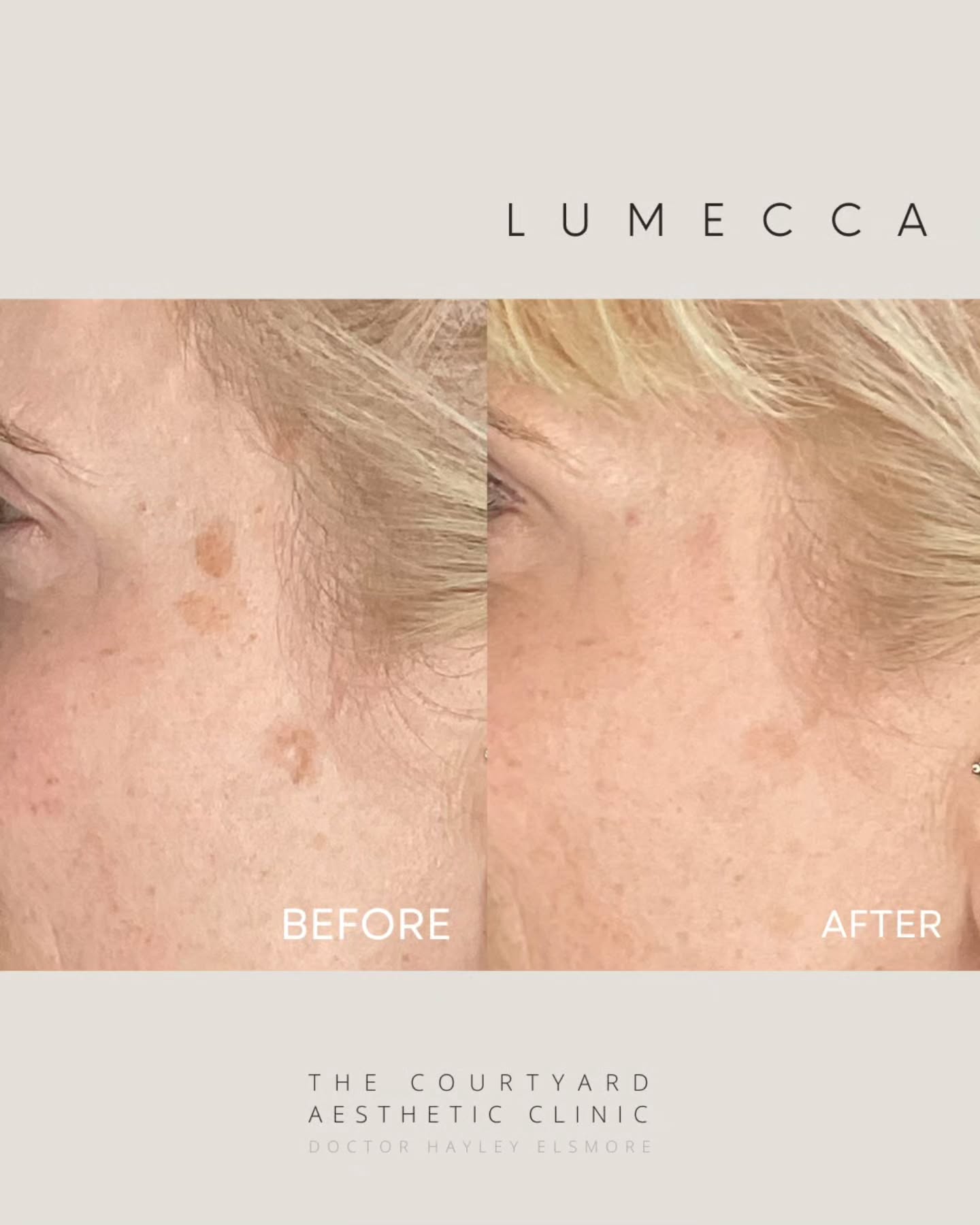 Lumecca once again showing us that the smallest improvements can make the biggest difference to our confidence ✨
Just one session and look how much this area of UV pigmentation/age-related spots have lifted 🙌
It’s not always about dramatic changes — often it’s those little refinements that leave us looking brighter and feeling fresher.
Free skin consultations are available to book online, or simply call us today to get your skin journey started!
•
•
•
#lumeccainmode #ipllaser #lumecca #agespots #sunpigmentation #sundamage #fresher #skindoctor #aestheticclinicsoutheast #aesthetictreatment