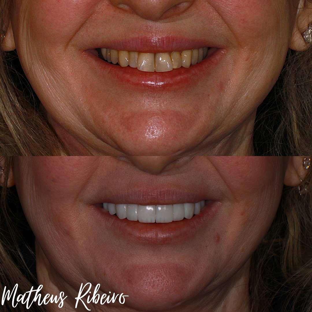 #OdontologiaEstética #Zircônia #zibase #ImplantesDentários #PróteseSobreImplante #Dentista#facetas #lentes #implantes #saudebucal #odontologia #tratamentoodontologico #dente #estetica #anapolis #implantezirconia #odontologiabiológica #odontolgiaintegral #odontologiabiologicaeintegrativa #dentistaanapolis #scannerintraoral