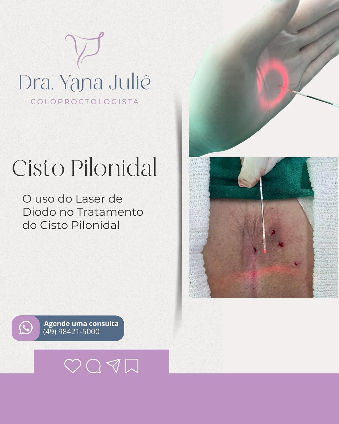 ✨Cisto Pilonidal e seu tratamento com Laser de Diodo.
O cisto pilonidal é uma doença associada a presença de pelos na região interglútea, que ao se misturarem com o suor e secreção sebácea, penetram para dentro da pele, formando cistos.
🚨Podem se apresentar de várias formas, como abscessos, orifícios que eliminam pus (fístulas), e espaços e túneis debaixo da pele.
Feito o diagnóstico, o TRATAMENTO É CIRÚRGICO, atualmente realizado com o auxílio do laser de diodo.
✨ O laser tem como vantagem tratar o cisto por baixo da pele, sem necessidade de cortes, acarretando em um tratamento mais simples, com menor dor no pós-operatório.
Não deixe esse incômodo atrapalhar sua vida…
Agende já sua consulta.
Dra. Yana Juliê Perondi
Coloproctologista
CRM: 29717 || RQE 27567
#Proctologia #ProctoChapeco #DoençasOrificiais #SaúdeAnal #Chapeco