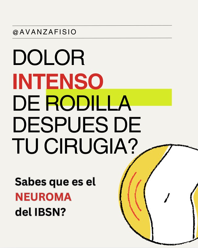 🩺 El dolor crónico tras una cirugía de rodilla no siempre es “normal”.
⚡️En muchos casos, una pequeña rama nerviosa ignorada —el IBSN— puede ser la causa real del sufrimiento persistente.
📊 Estudios muestran que, con el diagnóstico correcto y el tratamiento adecuado, el 80 % de los pacientes mejora, y más del 70 % recupera calidad de vida y funcionalidad.
🌱 No ignores ese ardor, esa hipersensibilidad, esa molestia que no se va.
Hay opciones. Hay alivio. Hay esperanza.
#NeuromaIBSN #DolorNeuropático #Rodilla #TKA #fisioterapia #dolorpersistente #Rehabilitación #artroscopía #artroscopíaderodilla #avanzafisioterapia #vamospormas