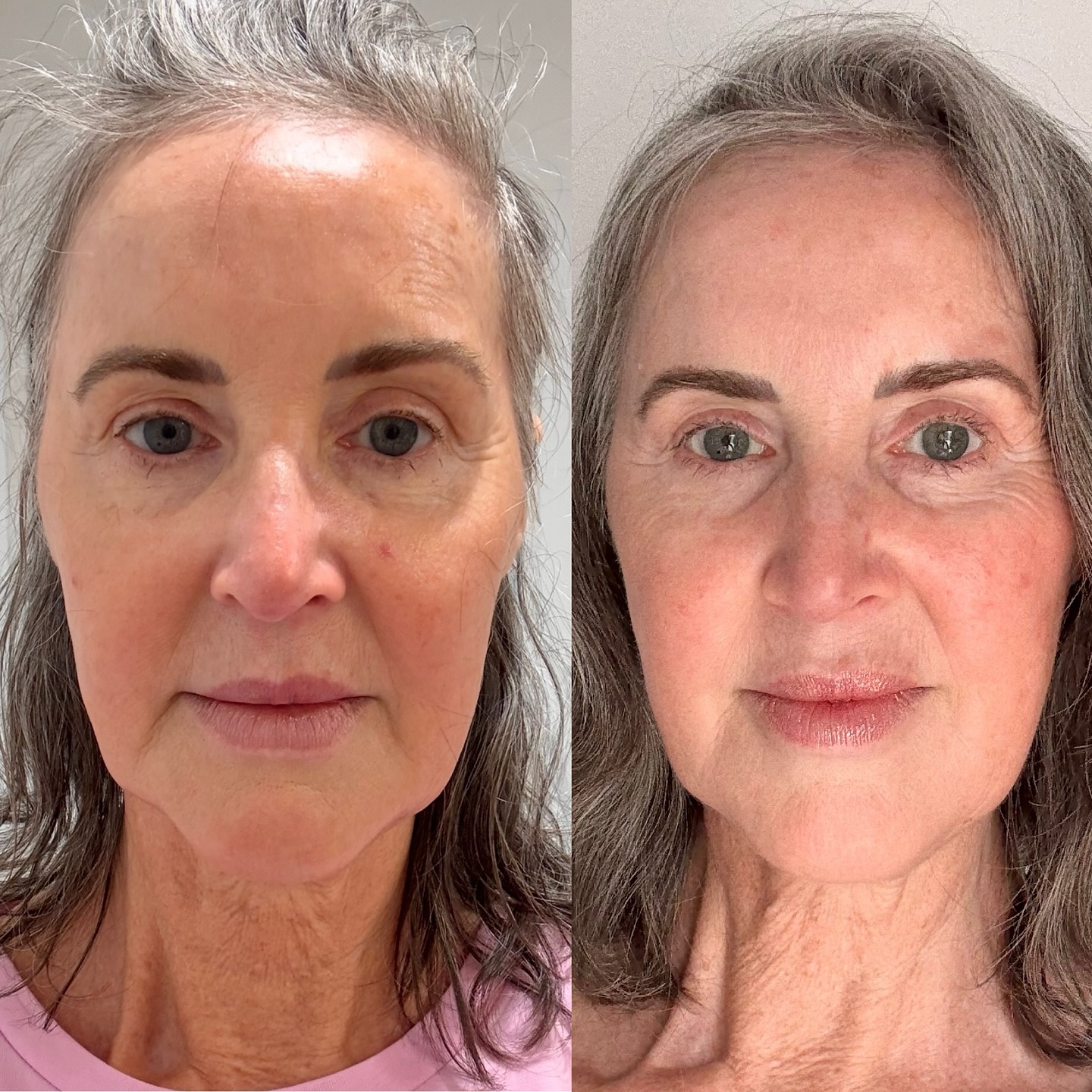 Excuse us why we sit in awe of this amazing transformation of @positivelyforeveryoung lower face after 6 @emface.btl sessions. Look at the lift in her jawline and the redistribution of fat from there to her cheeks giving her a more vibrant lifted appearance.
💛
#OgeeFacialRejuvenation
#cosmetictreatments #facialenhancement #NonSurgical #Emface #emfacetreatment #noninvasivetreatment #noninvasivefacelift #collagenboost #medicalaesthetics
#canberraskinclinic #cosmetictreatments
@btlaestheticsanz