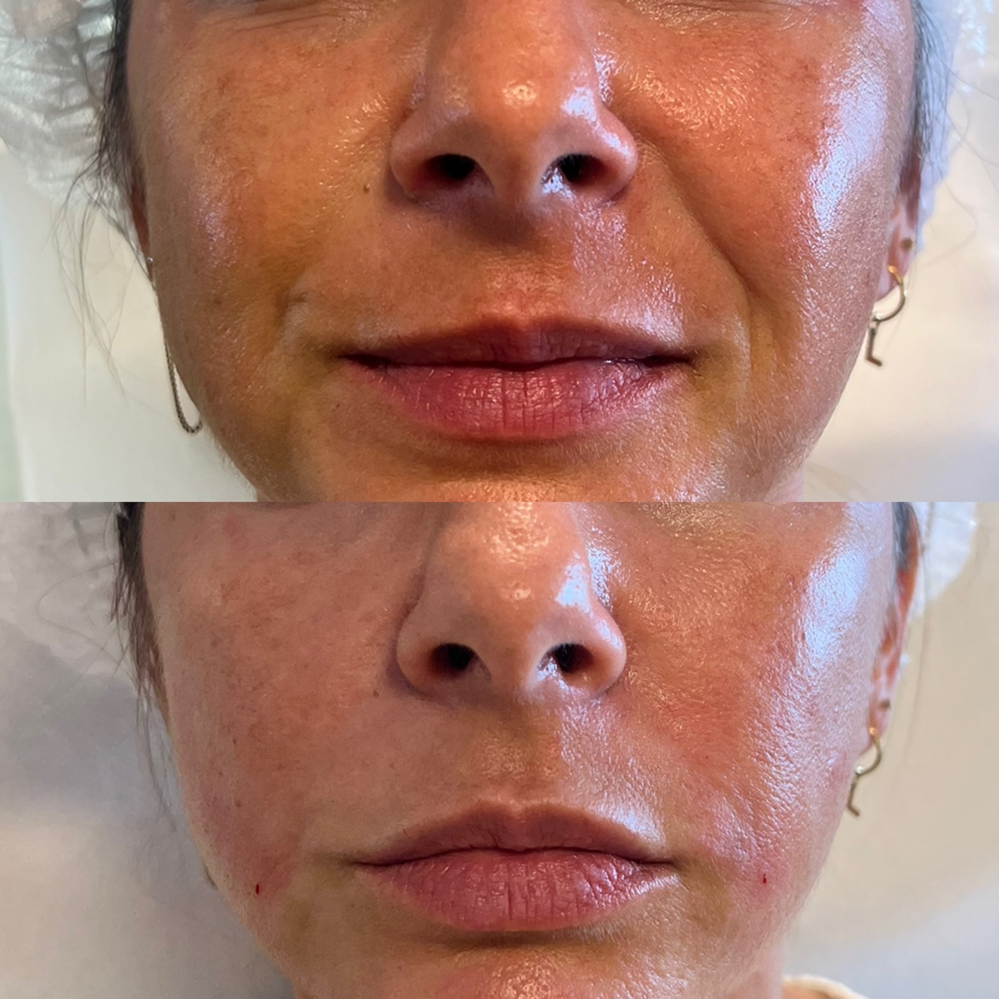 Travail du Middle Face avec de l’acide hyaluronique ✨✨