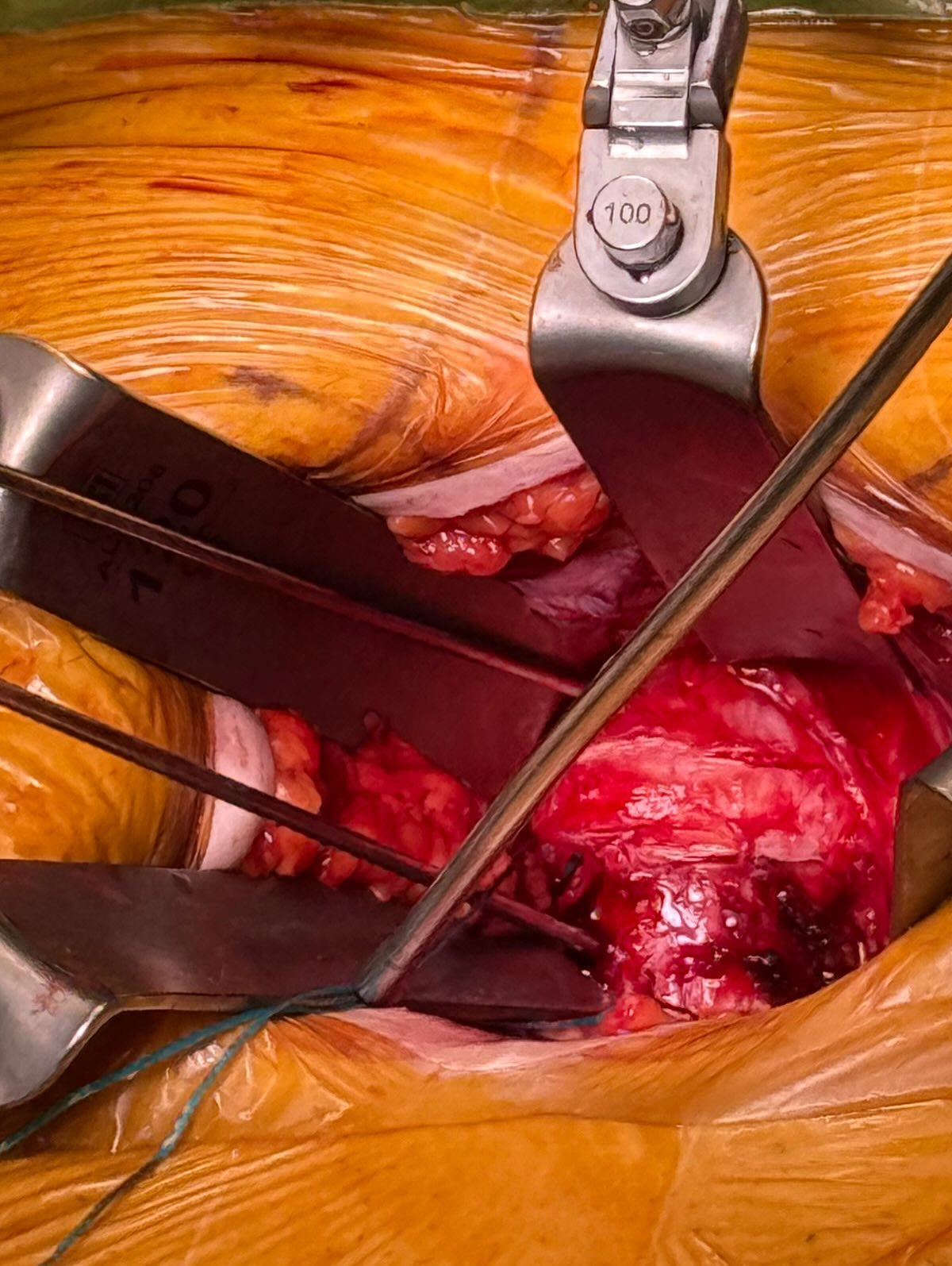 Fusión intersomática lumbar mediante abordaje ALIF
#cirugiadecolumna #artrodesislumbar #alif