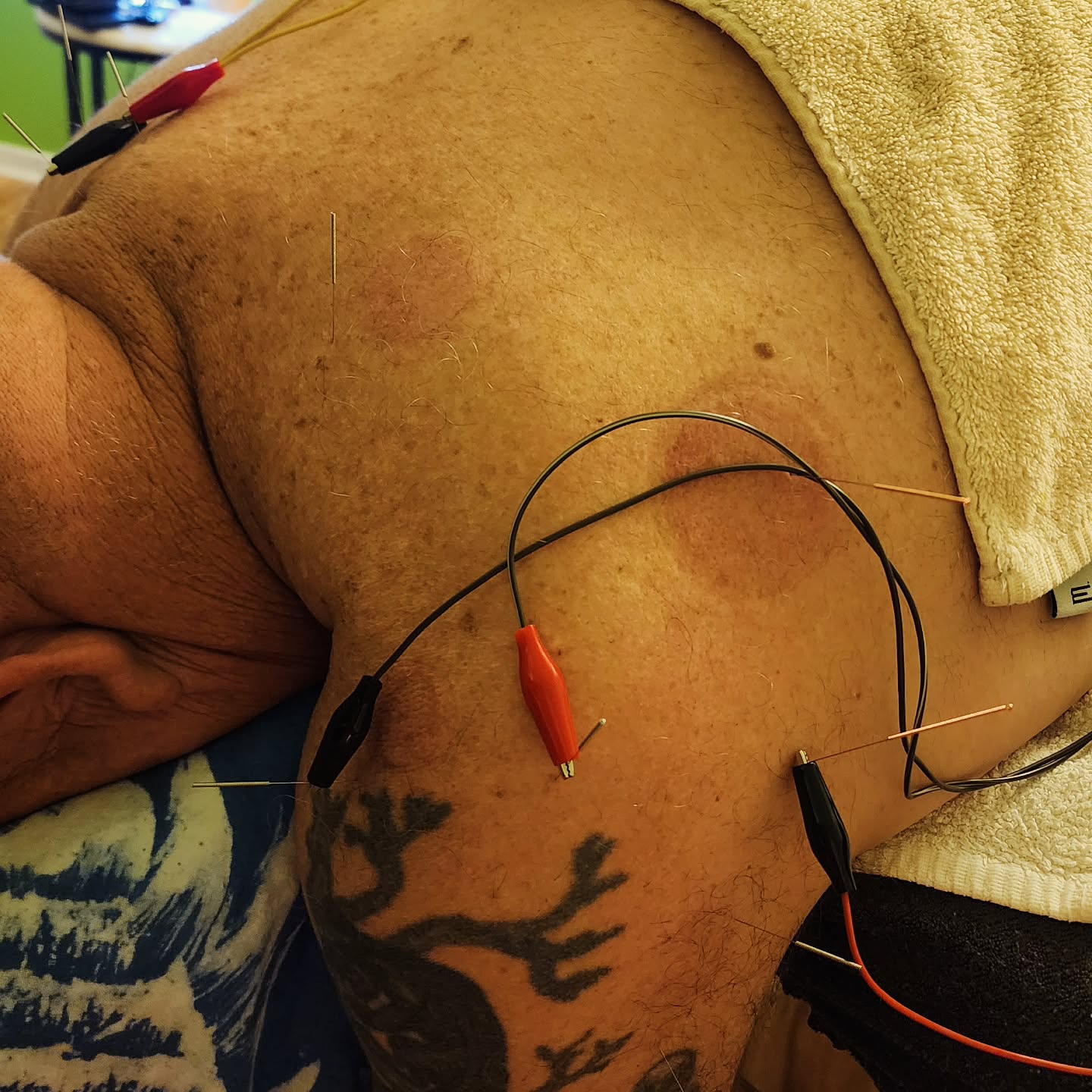 Treatment for neck and shoulder today 😌
>>>
#acupuncturelife #acupunctureneedles #electroacupunture #acutepain #chronicpain #acupuncture #acupuncturedoctor #acupuncturist #shoulderpain #elbowpainrelief #acupunctureworks #acupuncturerocks #acupuncturebrisbane #acupuntura