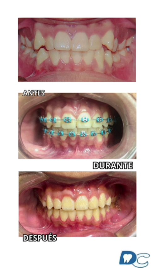 ✨Nuestro reciente caso de finalización de ortodoncia.✨
*Paciente David con plan de ortodoncia total de 2 años
*Inicia ortodoncia este mes de amor y amistad en pareja por tan solo 50.000