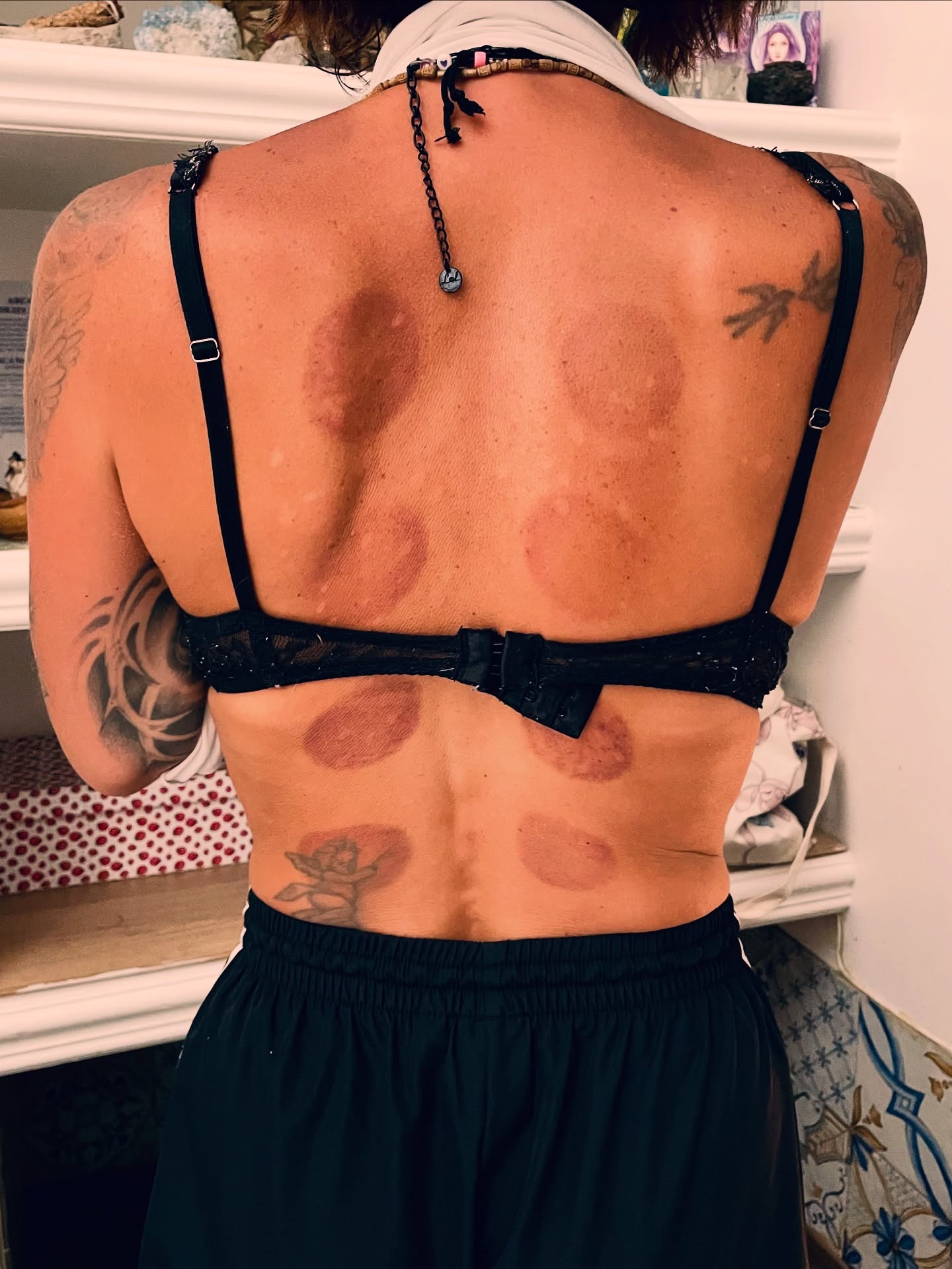 ✨What is Cupping Therapy? ✨
Cupping is a SUPER relaxing massage technique that breaks up knots and reduces muscle tension while deeply calming the nervous system. It’s also a powerful way to support the body’s natural healing process.
Suction is created with small cups, which are applied to different parts of the body like the back, neck, abdomen or thighs. The cups draw out toxins and stagnant liquids to the surface, facilitating the body’s ability to cleanse while activating the circulatory and lymphatic systems.
It can be used to release muscle tension, kickstart digestion, or to reduce water retention and the appearance of cellulite.
🌿 Amazing Cupping Benefits:
• Immediately calms your nervous system, making it a great choice for soothing anxiety & getting better sleep
• Powerfully detoxes the body and activates circulation, moving out old blood, lymph, cellular debris & even stored residues (like from medications or inhaled smoke)
• Softens scars & adhesion
• Releases inflammation via vasodilation (a natural “counter-irritant”)
• Supports immune function and helps get over colds/coughs more quickly by moving out mucus & stimulating lymph flow
• Provides pain relief by relaxing tense muscles and supporting sports recovery—many athletes swear by it!
☀️ Precautions & Aftercare Tips
To get the most out of your cupping session (and keep your body supported afterward):
• Stay hydrated – drink plenty of water to help your body flush out what’s been released
• Keep the area warm & covered – avoid drafts and direct sunlight for 1–2 days
• Skip sensitive areas – no cupping over wounds, rashes, varicose veins, or sunburn
• Avoid during pregnancy – cupping isn’t recommended
• Health check-in – let your therapist know if you have anemia, take blood thinners, or have any circulatory/bleeding disorders
✨ And about those circular marks: they’re not bruises. They’re a sign that stagnation and toxins have been pulled to the surface and are on their way out.
Here’s to your healing and highest good!
With love,
Teressa @joyfulheartacuwellness
#cuppingtherapy #cuppingrome #traditionalchinesemedicine #acupuncturerome #holisticwellness #healingfromtheinside
