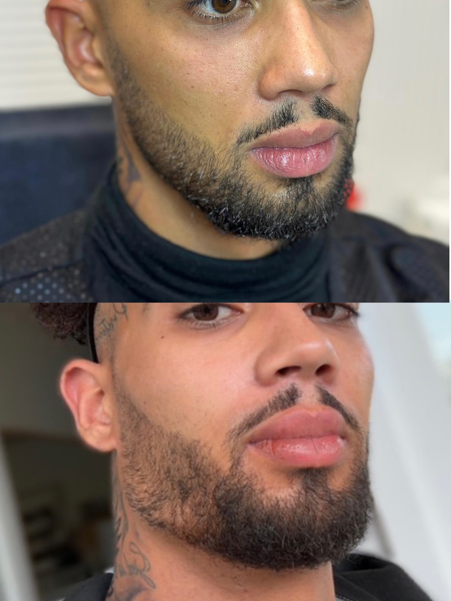 Masculinisation jawline homme ✨✨✨✨