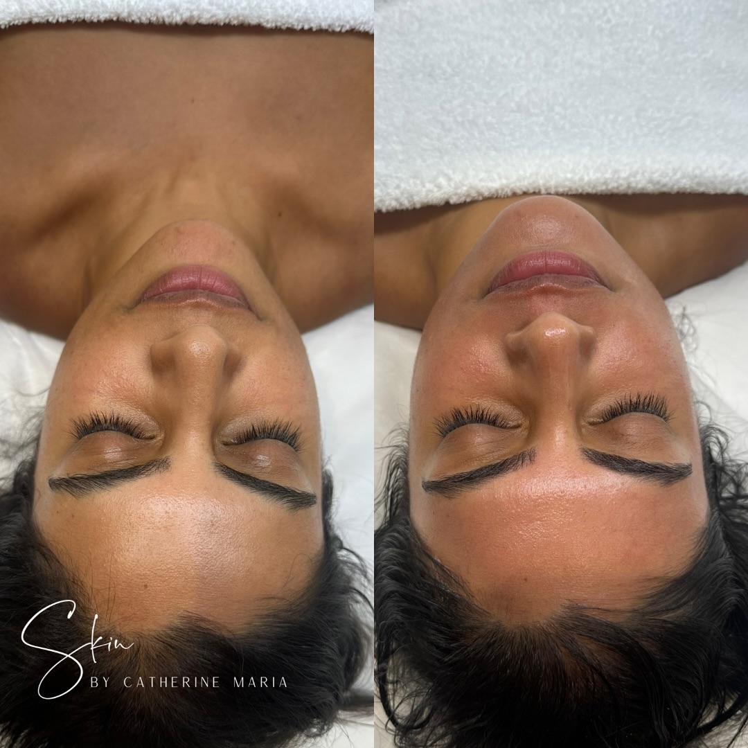 The treatment everyone talks about…
Because the results speak for themselves.
On Saturday, my lovely client left glowing after just one session, swipe to see the before and after 🥰
This unique peel uses algae, herbs and perfluorodecalin which is an advanced skincare ingredient known for its ability to carry oxygen into the skin, helping to boot cell renewal and repair.
To enhance the results even further, we finished with Dermalux LED light therapy as an add-on, leaving the skin calm, soothed and radiant.
- Stimulate cell renewal
- Refine skin texture
- Brighten and even the complexion
- Reduce congestion and impurities
It’s gentle, natural, and effective - making it one of my most requested advanced treatments.
Have you experienced the DÉCAAR algae peel? Maybe this is your sign to have this at your next appointment.
September spaces are limited, so if you’d love to experience the DÉCAAR treatment this month, now is the time to book.
🗓️ Book via the link in bio
📍 Aylesbury, Buckinghamshire
📞 07759567391
📩 info@skinbycatherinemaria.com
🌍 www.skinbycatherinemaria.com
#aylesbury #aylesburybusiness #aylesburyvale #aylesburymums #aylesburyfacials #aylesburybeauty #aylesburybeautysalon #aylesburytown #buckinghamshire #buckinghamshirebusiness #buckinghamshirewedding #buckinghamshiremums #buckinghamshirelife #buckinghamshirebeauty #fairfordleys #berryfieldsaylesbury #kingsbrookaylesbury #westonturville #stokemandeville #wendover #astonclinton #waddesdon #haddenham #longcrendon #decaaralgaepeel #decaar