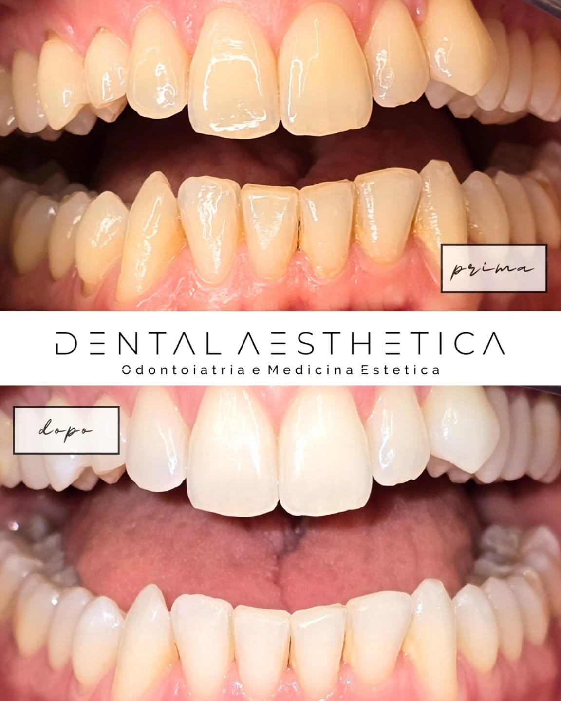 🦷Sapevi che puoi sbiancare i tuoi denti comodamente da casa?
Come?
Con la nostra terapia di sbiancamento domiciliare, ti basterà indossare delle apposite mascherine per 14 notti e, applicando un gel al loro interno, otterrai un risultato sbiancante efficace e duraturo
La procedura?
▫️Prendiamo un'impronta digitale della tua bocca
▫️Stampiamo le mascherine sulla base della tua dentatura
▫️Ti consegnamo gel e mascherine, da indossare per 14 notti
ℹ️ Vuoi maggiori informazioni e prezzi?
Contattaci subito!
📞 375 88 47 069
📍 viale della Grande Muraglia 256
#dentista #sorriso #sbiancamentodenti #dentistaroma