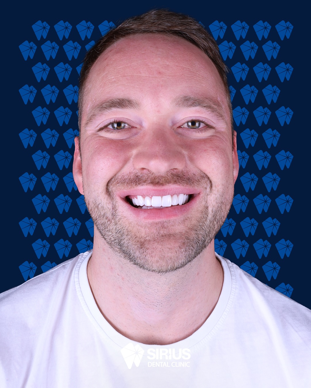 ✨ Голливудская улыбка — это не мечта, а реальность! ✨
Мы сопровождали Александра Гельта на протяжении всего комплексного лечения.
📍 Проведено эндодонтическое лечение зубов №25 и №15.
📍 Удалена киста на корне зуба №25.
📍 Удалены восьмёрки: №18 и №28 (верхняя челюсть), №48 и №38 (нижняя челюсть).
📍 В нижнюю челюсть установлены 4 импланта на место отсутствующих зубов.
📍 Проведена обточка сохранившихся зубов верхней и нижней челюсти и установлены циркониевые коронки.
Каждый этап был тщательно спланирован и выполнен с особой точностью.
🦷 Теперь у него не только здоровые, но и по-настоящему сияющие зубы!