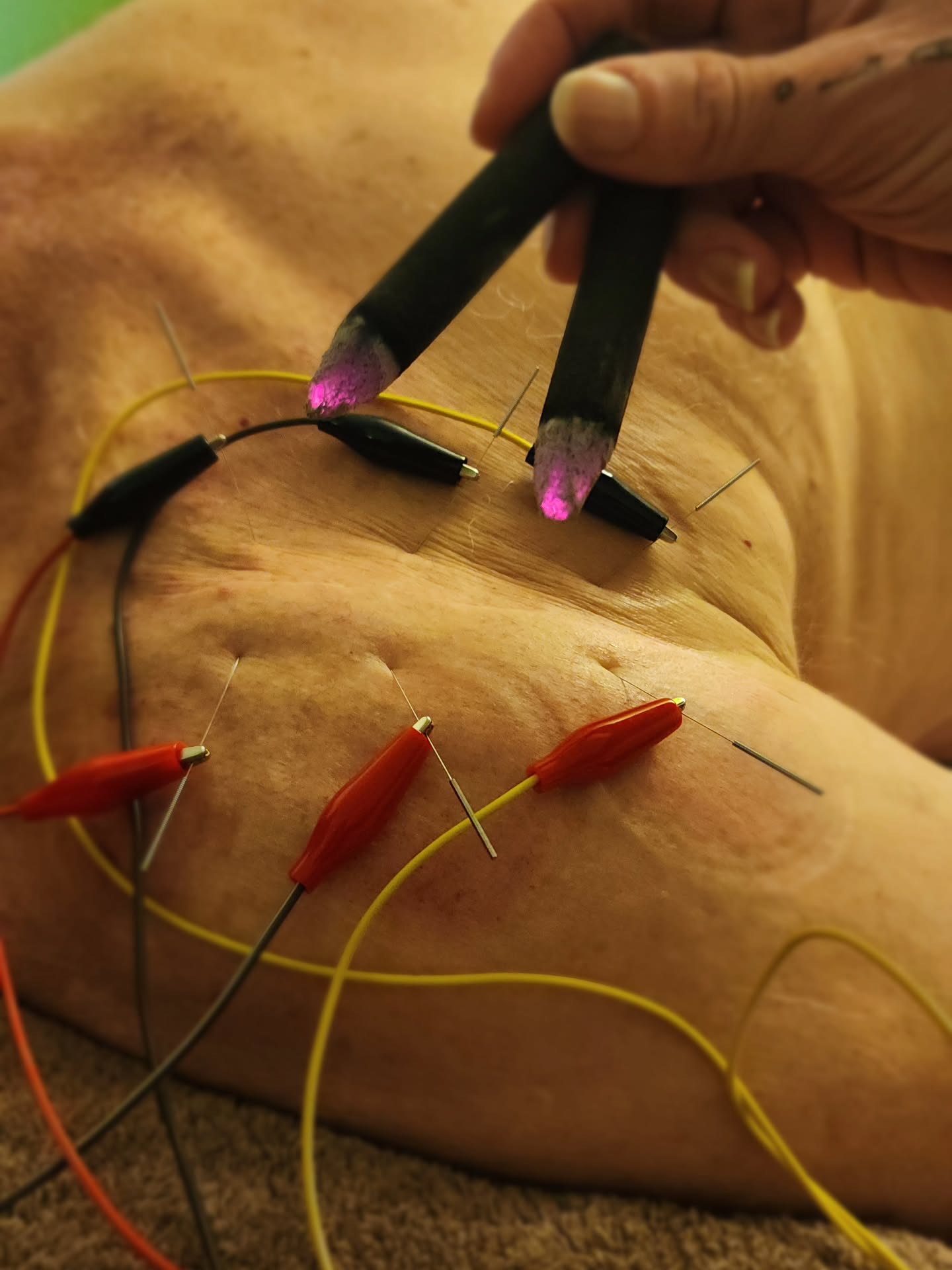 All the needles. All the electro. All the heat.
>>>
#acupuncturelife #acupunctureneedles #electroacupunture #acutepain #chronicpain #acupuncture #acupuncturedoctor #acupuncturist #shoulderpain #elbowpainrelief #acupunctureworks #acupuncturerocks #acupuncturebrisbane #acupunctureforpain #scar #scars #scartreatment