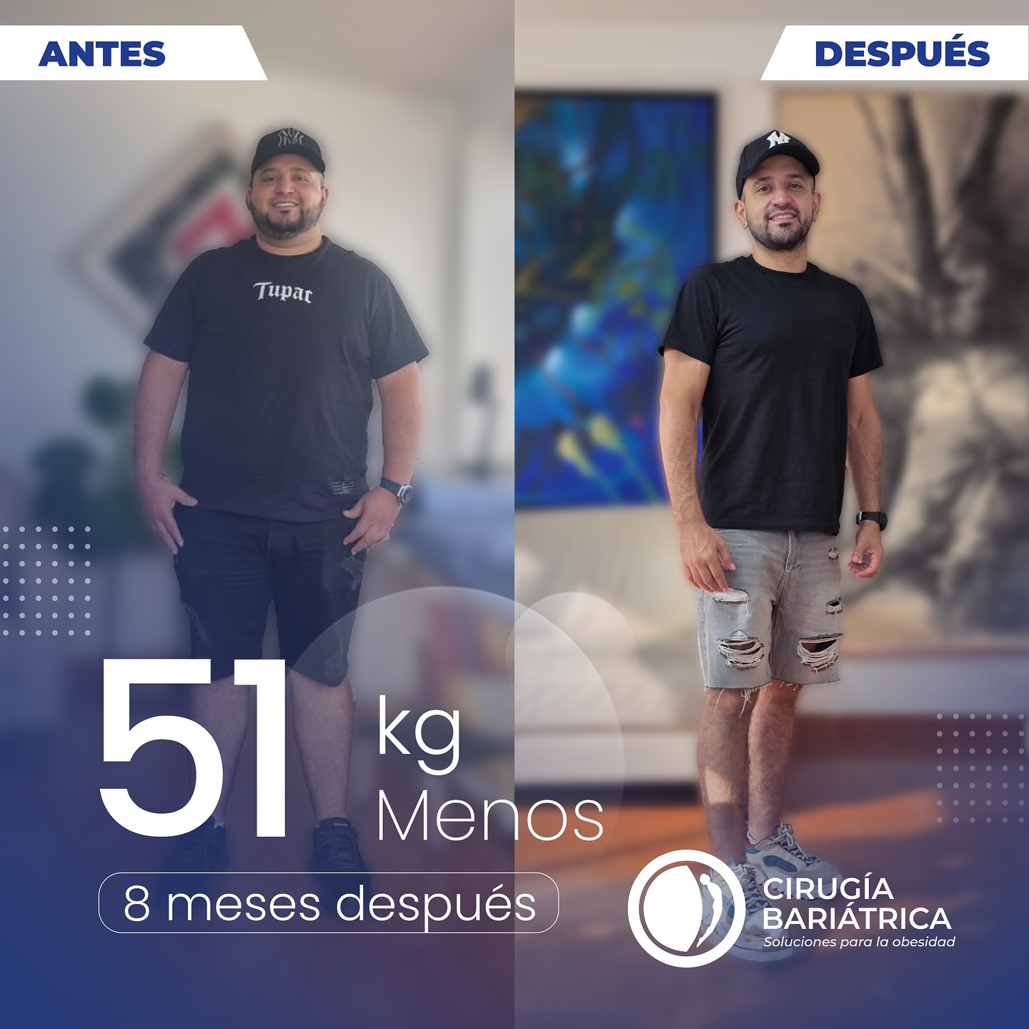 ¡51 kilos menos en solo 8 meses! 🙌 Gracias a la cirugía bariátrica del Dr. Eduardo Bolaños y su equipo de trabajo, este paciente transformó su vida con resultados reales, seguros y de la mejor calidad. 💙✨ Profesionalismo, compromiso y tecnología al servicio de un cambio que va más allá del peso: una vida nueva.
112 pounds less in just 8 months! 🙌 Thanks to Dr. Eduardo Bolaños and his team, this patient transformed their life through bariatric surgery with real, safe, and high-quality results. 💙✨ Professionalism, commitment, and advanced technology delivering a change that goes beyond weight: a brand new life.
#bariatric #bariatrica #bariatricsurgery #weightlossstory #weightlossjourney #healthychoices #healthy #health