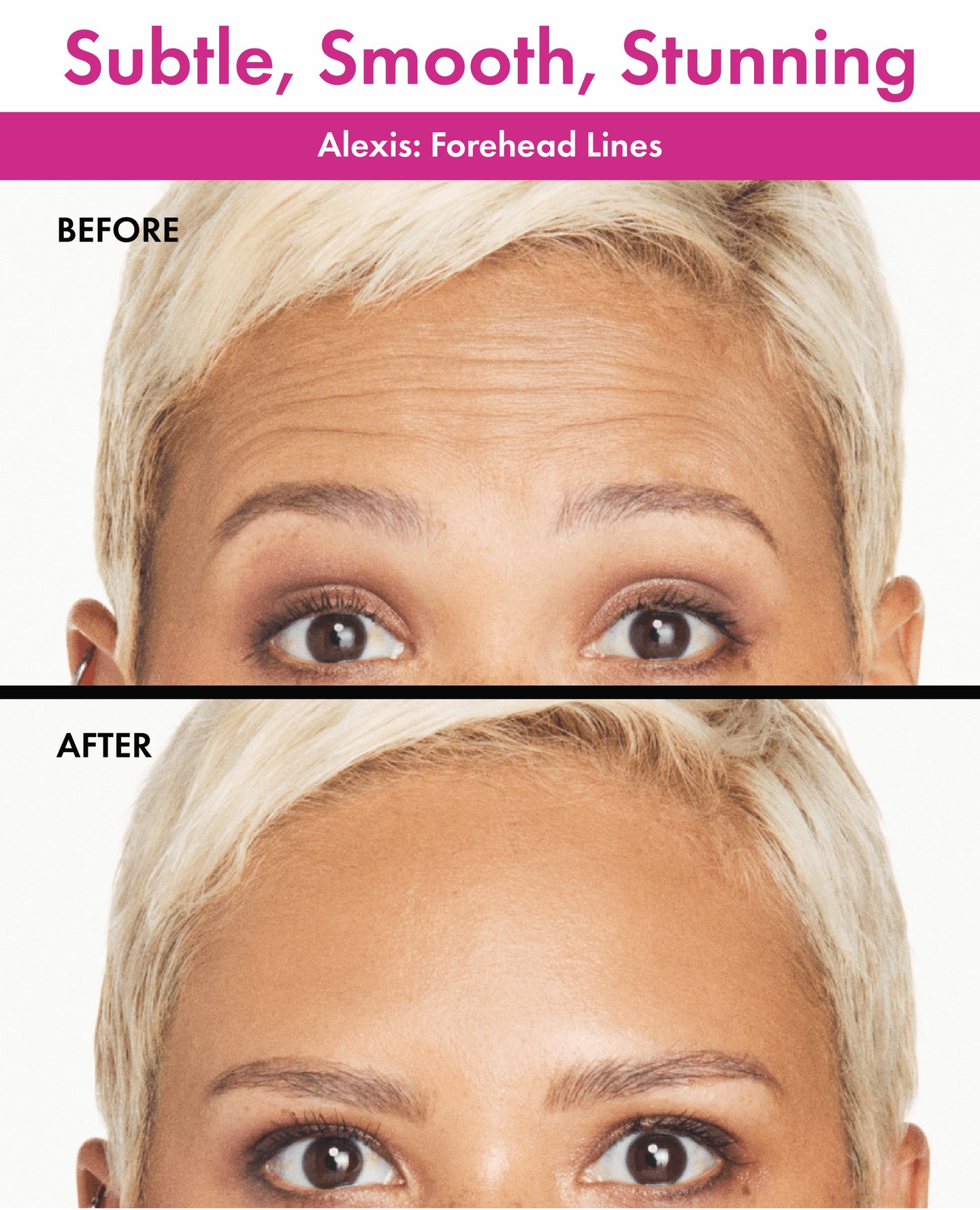 Subtle, smooth, and beautifully you ✨
These Xeomin® results show just how refined a little refresh can be.
📅 Book your appointment today at sierramedicalaesthetics.com
