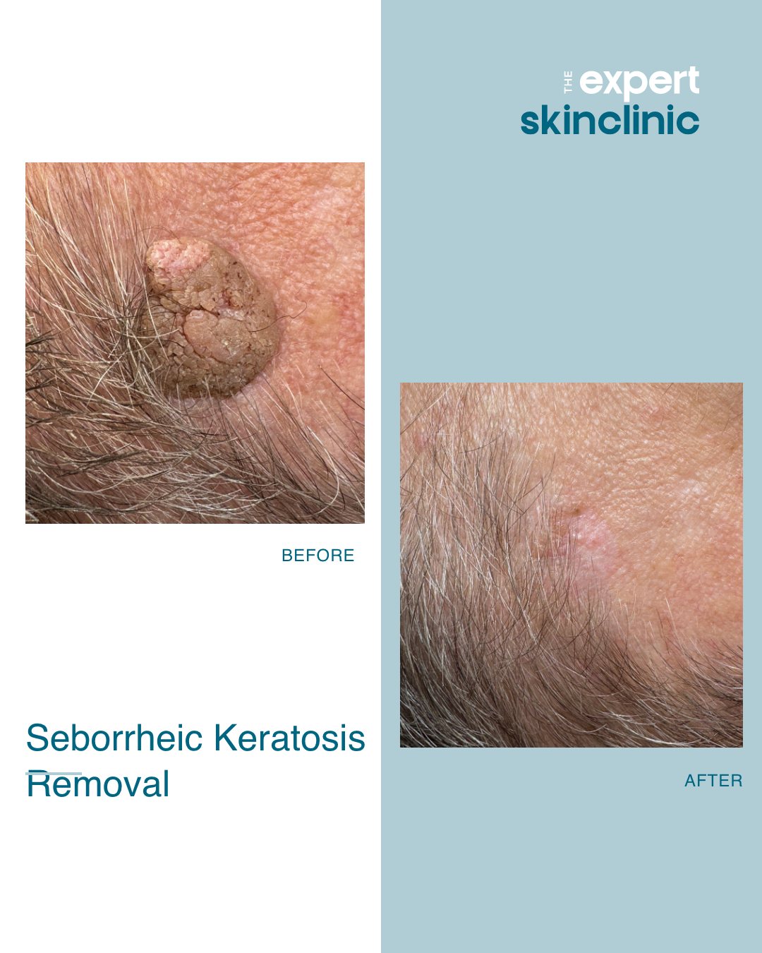We're proud to share this incredible before and after transformation!
This client had a large Seborrheic Keratosis on their head. Whilst this type of blemish is most commonly pretty harmless, it can cause some discomfort or consciousness.
We treated this with advanced electrolysis, otherwise known as advanced cosmetic procedure. Just 6-weeks post treatment, the blemish is completely gone! As you can see, there is a slight indentation and some redness, which is a normal part of the healing process and will continue to fade over time.
We're so thrilled with these results, and so is the client💙
If you have a similar lesion to this one or something else that is bothering you or affecting your confidence, visit our website to book a consultation and we can take a look.
#seborrheickeratosis #blemishremoval #skinbeforeandafter #skintreatmentnorthampton