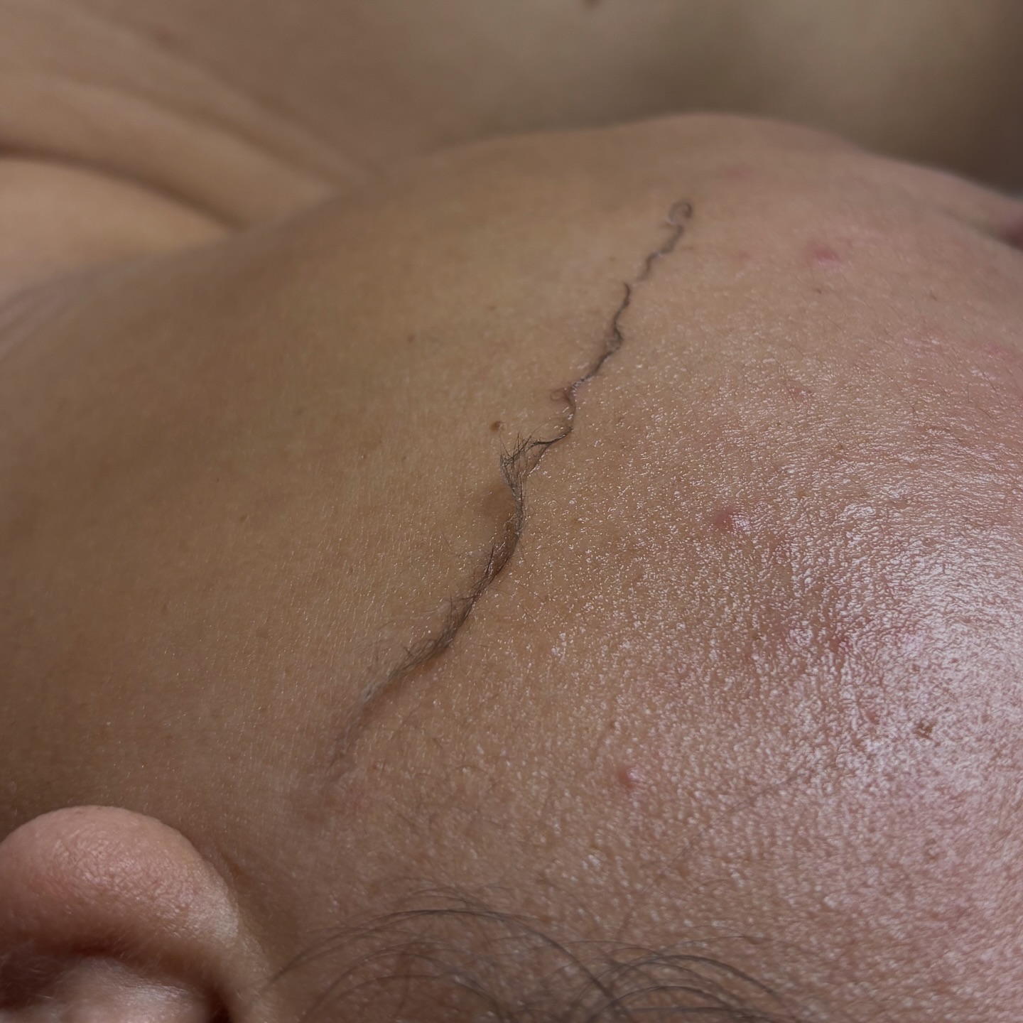 Ever wondered what dermaplaning really does for your skin? ✨⬇️
Dermaplaning gently removes that fine vellus hair (peach fuzz) along with dead skin cells, leaving your skin ultra-smooth and glowing. This allows your skincare products to penetrate deeper and work better.
At Sadie’s Skin Studio, I offer a 30-minute Dermaplane Session for $45 — a quick refresh with big results🎀
✔️ Exfoliates skin
✔️ Enhances product absorption
✔️ Removes vellus hair (peach fuzz)
✔️ Brightens dull skin
✔️ Instant glow
Most people can receive dermaplaning every 3–4 weeks. That’s because it lines up with your skin’s natural cell turnover cycle, ensuring the best results without over-exfoliating. For clients with more sensitive skin, stretching it to every 5–6 weeks may be more comfortable.