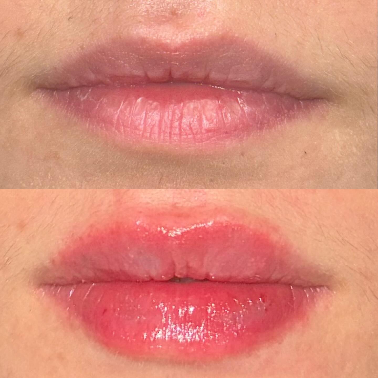 Filler used anywhere in the face should be undetectable and enhance your natural features🤗❤️
Using Restylane in the lips to improve proportions and symmetry whilst maintaining a natural appearance 🌟
#UKAesthetics #AestheticPractitionerlondon #FacialAestheticsUK #SkinClinicUK #LipFillerUK #BotoxUK #LondonAesthics #NonSurgicalAesthetics #AestheticsClinicUK #GlowUpUK