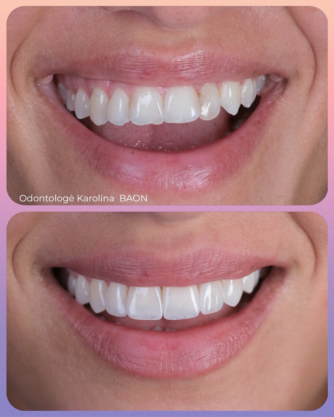 💎 Šypsenos transformacija 💎
Šiame rezultate – subtilūs, bet itin svarbūs pakeitimai:
✔️ plombuoti dantų galiukai, kad šypsena atrodytų vientisa ir harmoninga
✔️ vienas dantis visiškai padengtas dėl spalvos pokyčio – kad spalva susilietų su visais likusiais dantimis.
Rezultatas – natūrali, šviesi ir harmoninga šypsena 🌸
🌿 Kartais tereikia mažų, bet kruopščių pakeitimų, kad šypsena suspindėtų naujai!