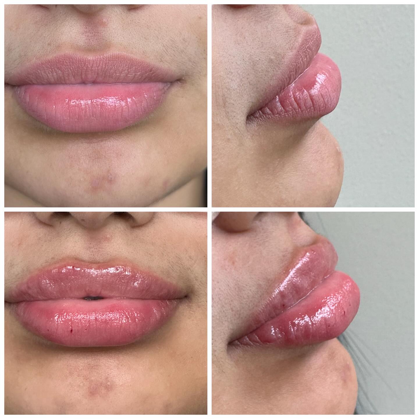 💋💉😘 Just a friendly reminder that you have a few weeks left in September to take advantage of our filler promo !!
📲971-375-6381 to book
#revanesselips #lipfillers #medspa #keizeroregon