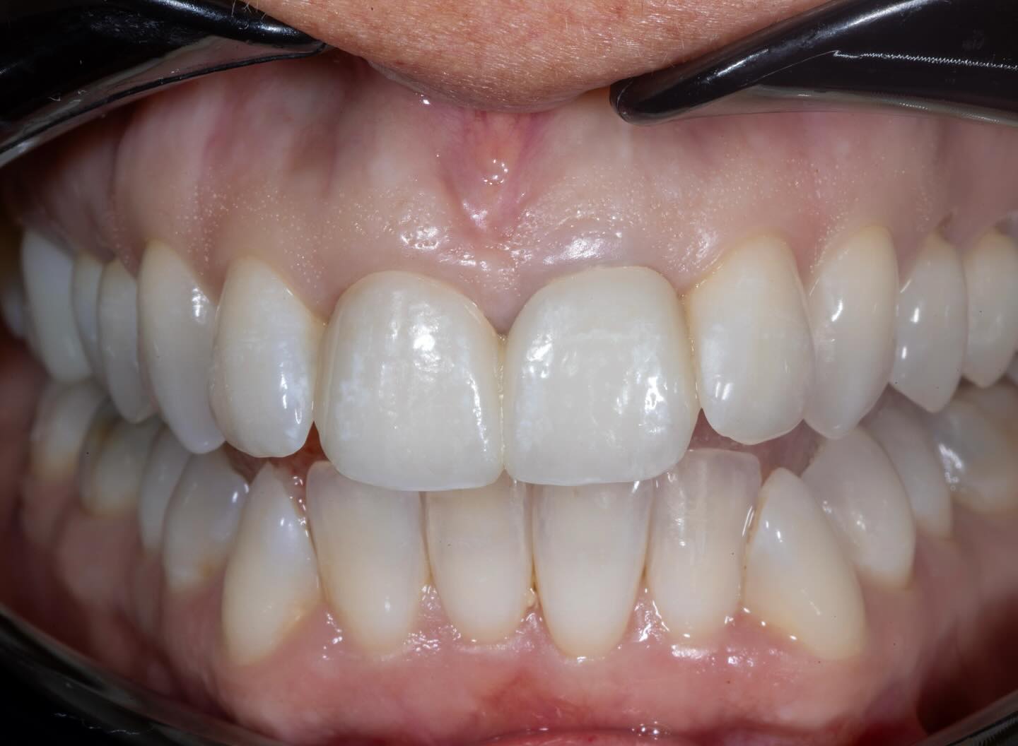 PMMA temps on 8 and 9, customized to blend seamlessly in the patients mouth 👌
#DentalLab #Crownify #CompositeVeneers #ProvisionalRestorations #SmileDesign #DentalEsthetics #CosmeticDentistry #DentalWork #LabLife