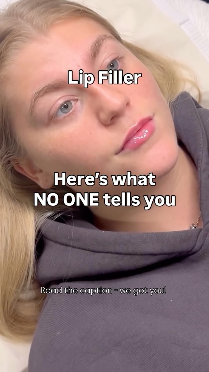 Let’s clear something up:
💉 Lip filler isn’t about changing your whole face.
The truth is:
✔️ Bad filler = poor technique or unqualified injectors
✔️ Good filler = balance, proportion, and personalisation
Lip filler isn’t the problem — bad filler is.
Here at Merci, we focus on:
• Natural enhancements
• Soft volume
• Honest consultations
Lip Filler is about:
✅ Adding volume where you lost it
✅ Balancing uneven lips
✅ Defining your Cupid’s bow
✅ Or just… finally having the pout you always wanted
Done right, it doesn’t scream “I had work done.”
It whispers: “I look good and I know it.”
💬 Be honest — ever stared at your lips and thought:
“They’re fine… but they could POP?”
Let’s talk about it in the comments ⬇️
Zero judgment. Just real results.
#LipFillerJourney #sheffieldaestheticsclinic #sheffieldaesthetics #sheffieldsalon #RelatableBeauty #NoShameInTheGlowUp #LipGoals #SubtleEnhancement #BeautyTalks