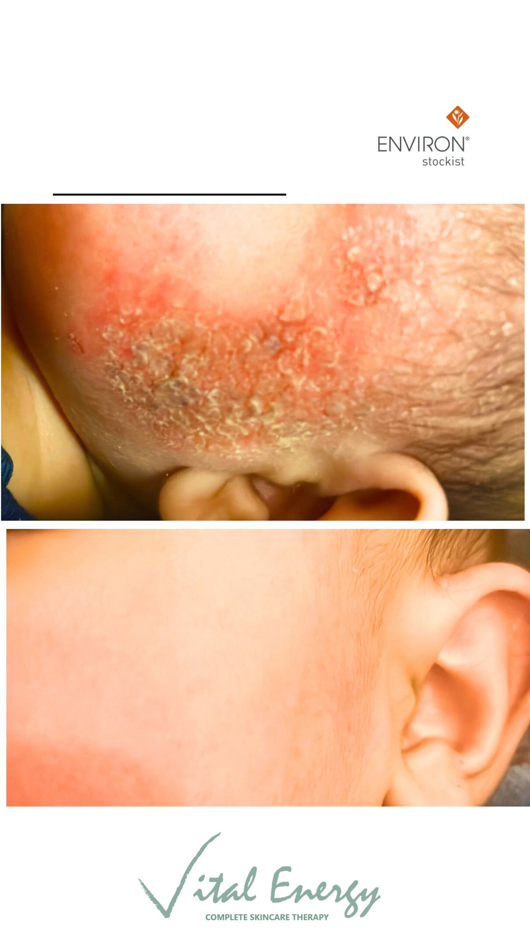 Vital Energy is a
Award Winning Salon👇
⭐️British Association of Beauty therapy and cosmetology
Semi finalists in Facialist category 2025
⭐️Therapist of the year Iiaa finalists 2023
⭐️Therapist of the year Iiaa pigmentation winner 2024
⭐️Therapist of the year Iiaa
Special mention 2025. #Eczema
#colostumgel
#environskincare
#iiaa
#babtac
#skincareprofessionls
#professionalbeautymagazine
#salonawards
DM for queries and consultations